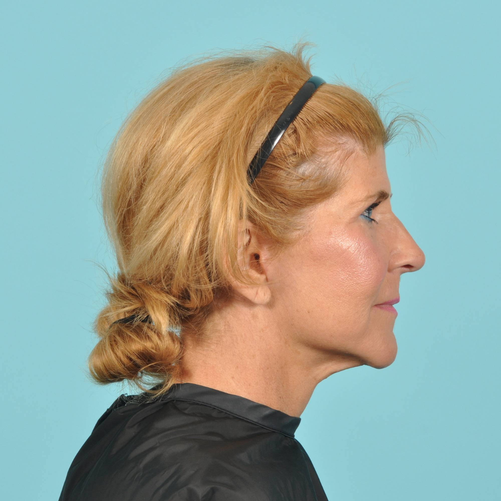 Facelift Before & After Image