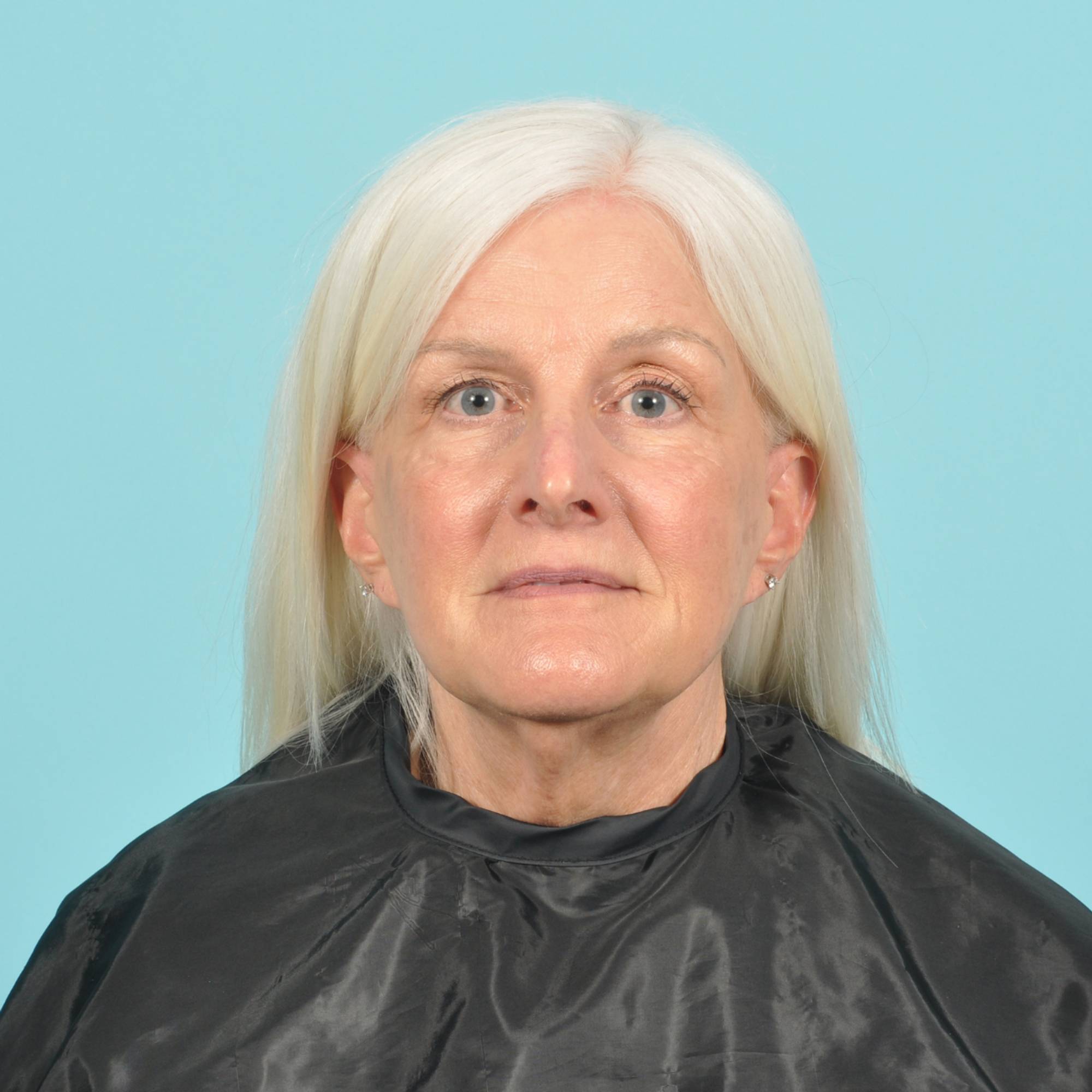 Facelift Before & After Image