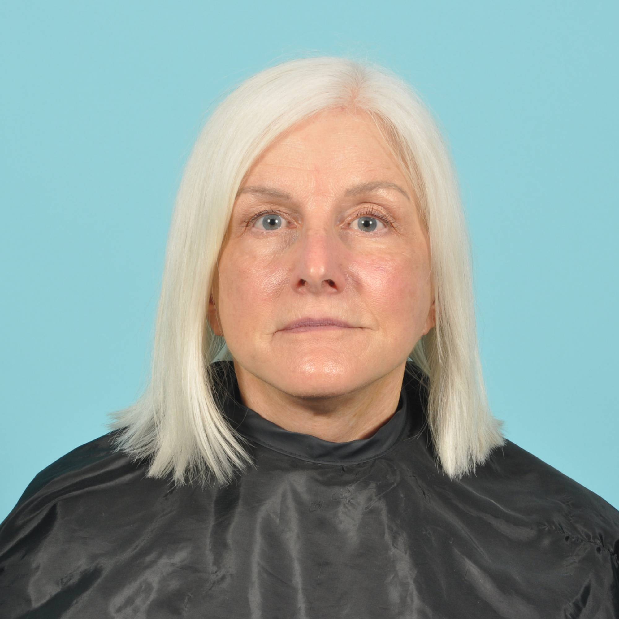 Facelift Before & After Image