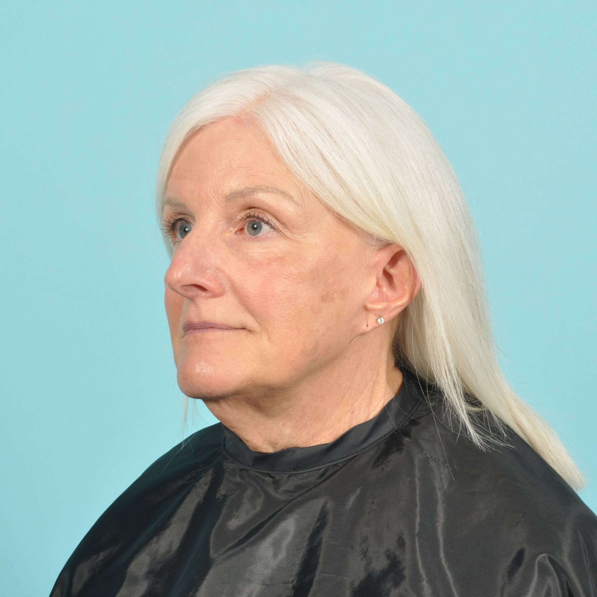 Facelift Before & After Image