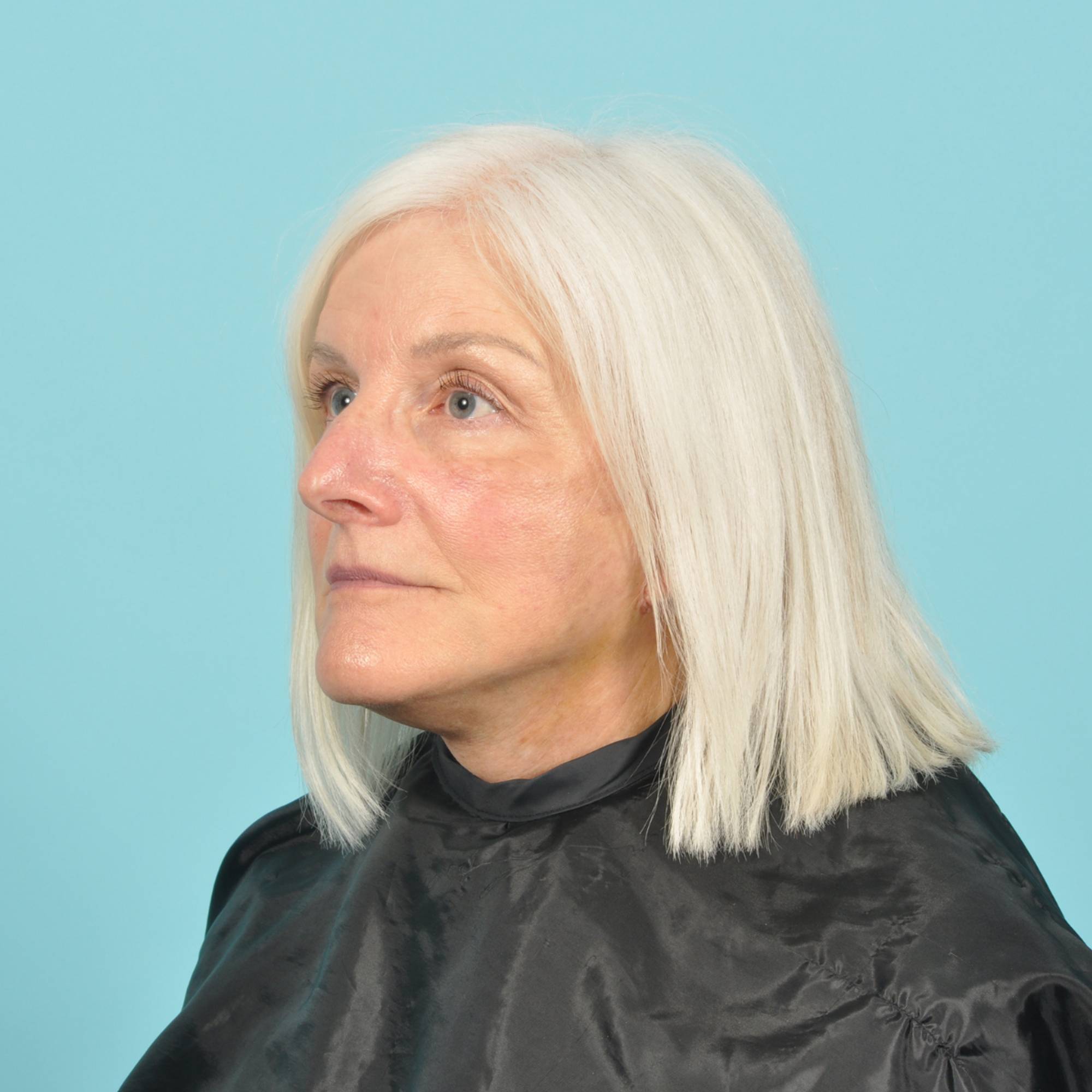 Facelift Before & After Image