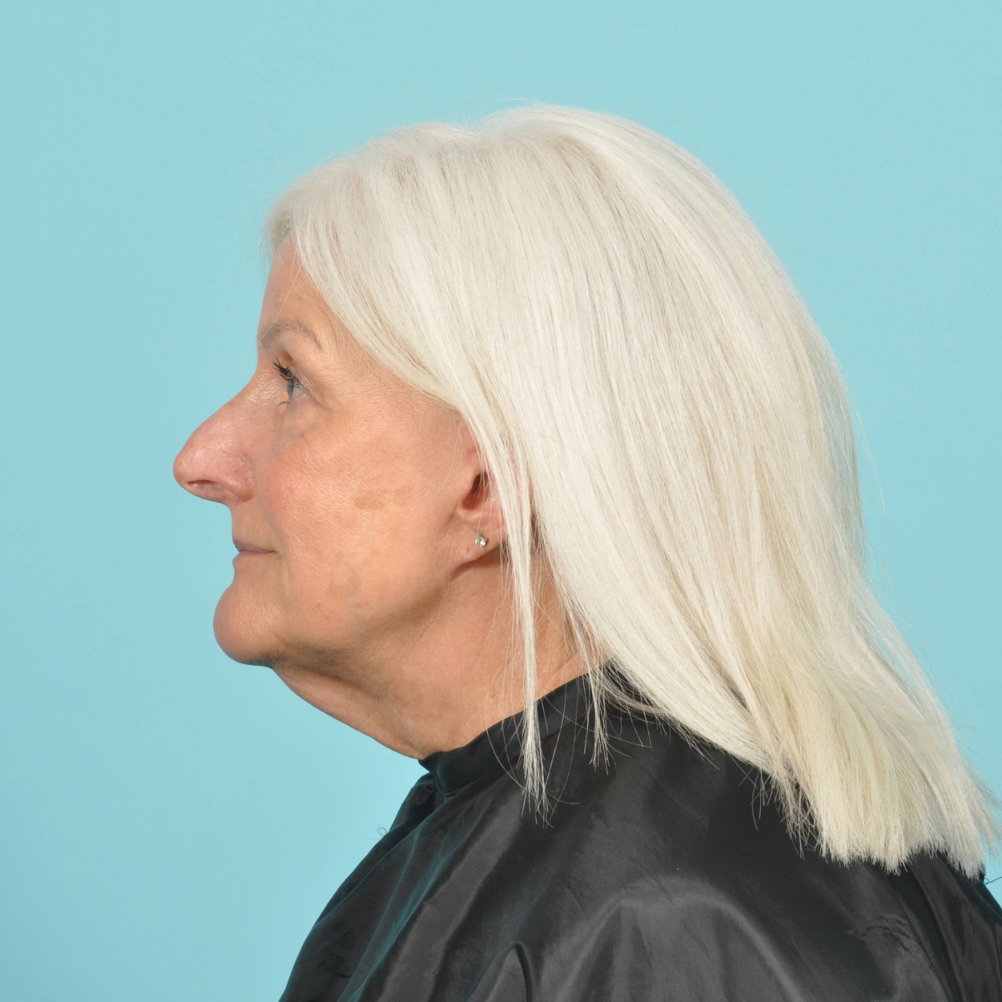 Facelift Before & After Image