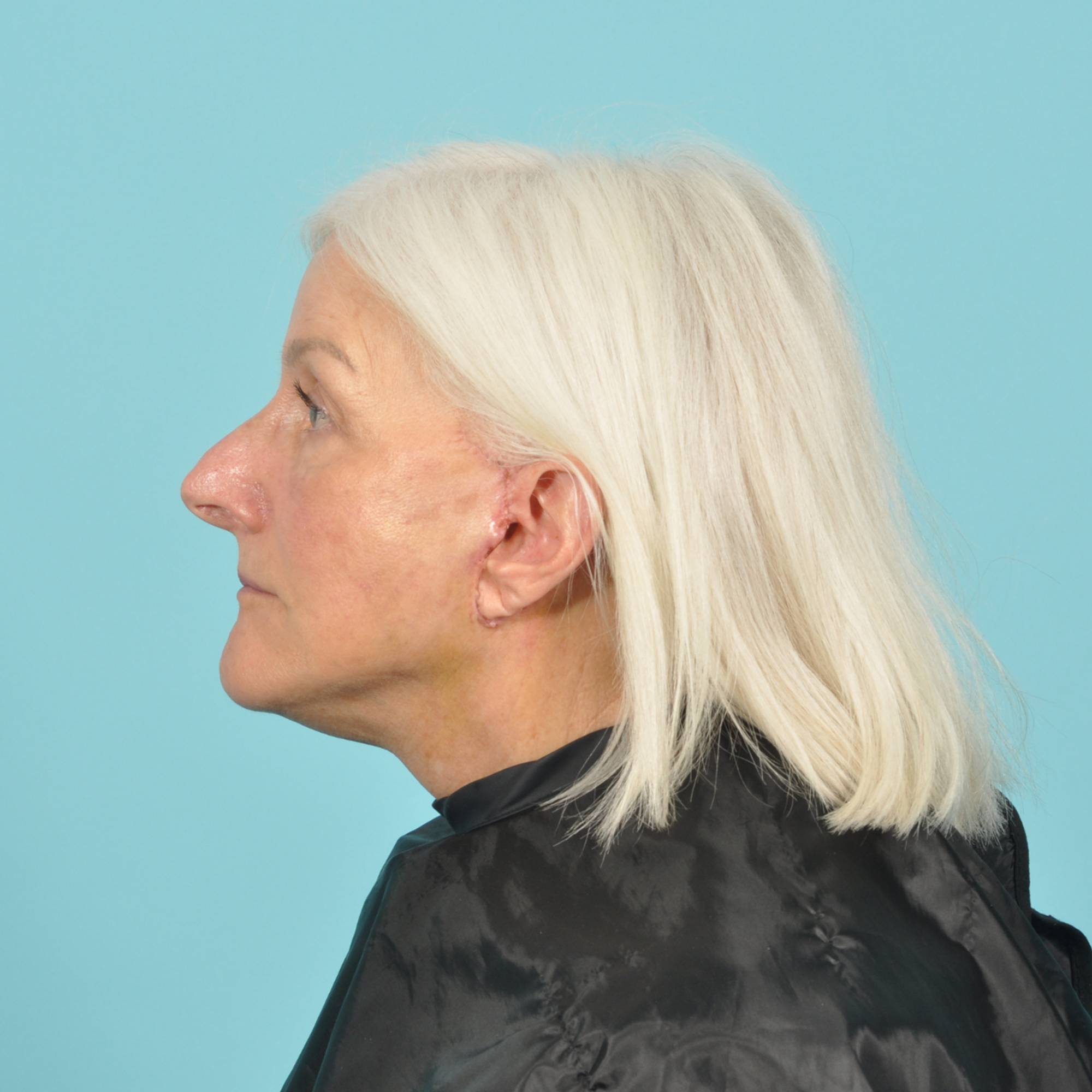 Facelift Before & After Image