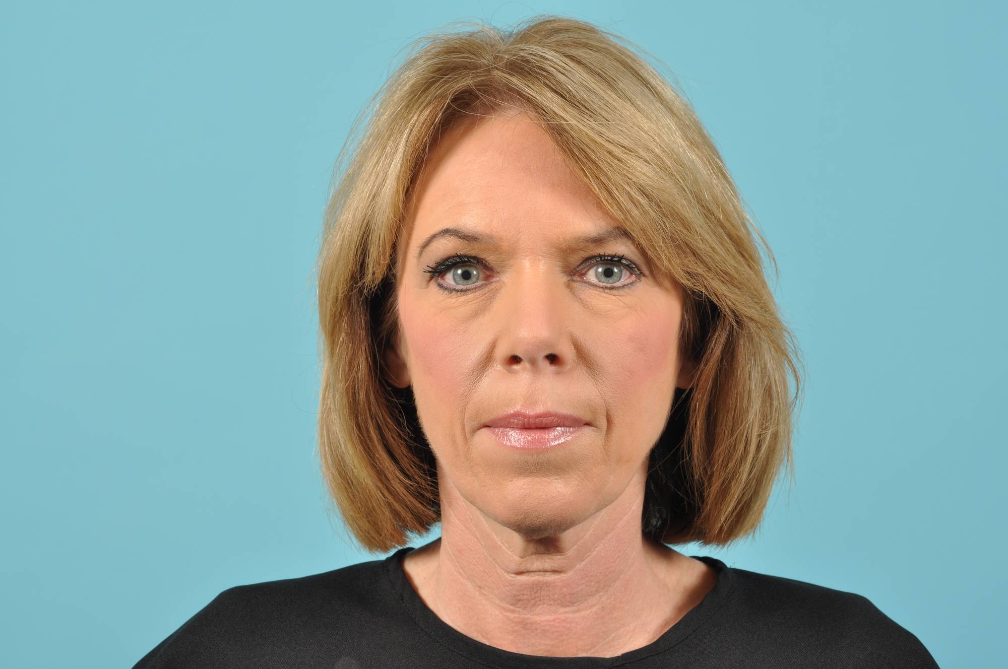 Facelift Before & After Image