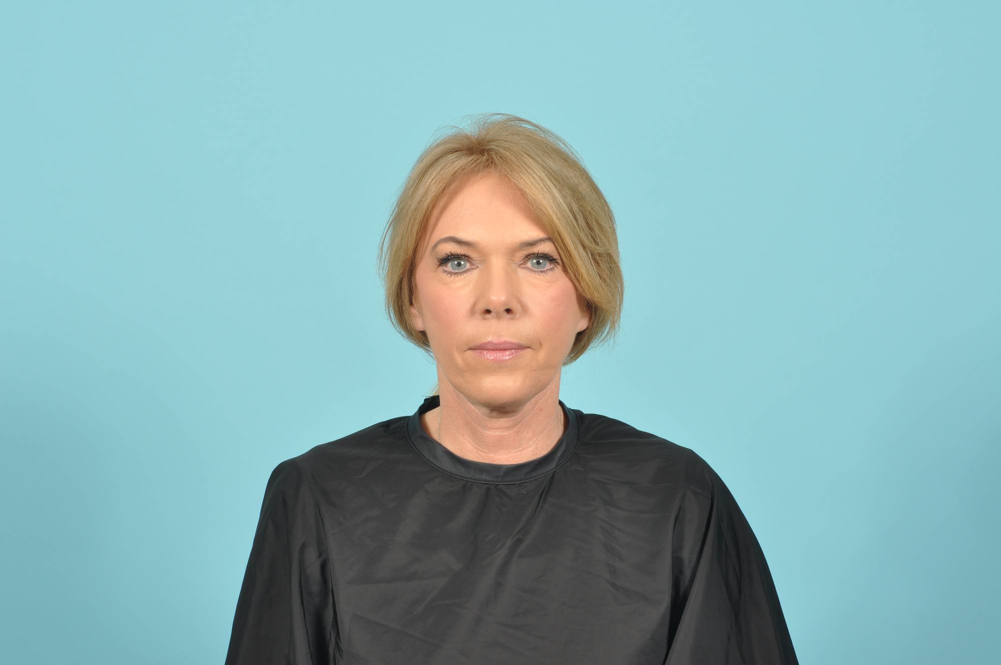 Facelift Before & After Image