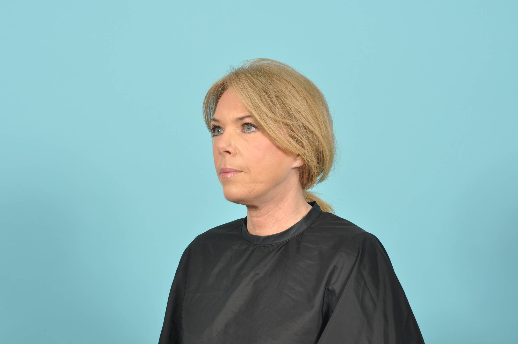 Facelift Before & After Image