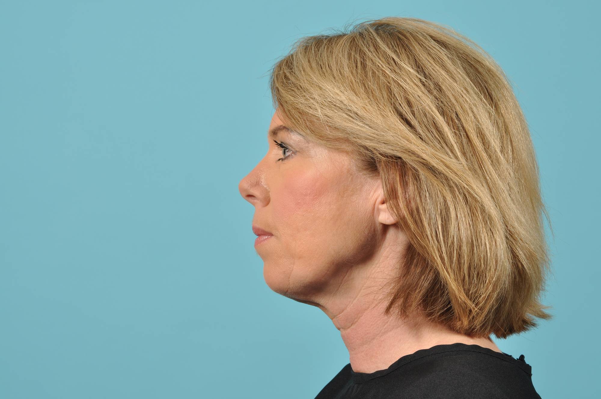 Facelift Before & After Image