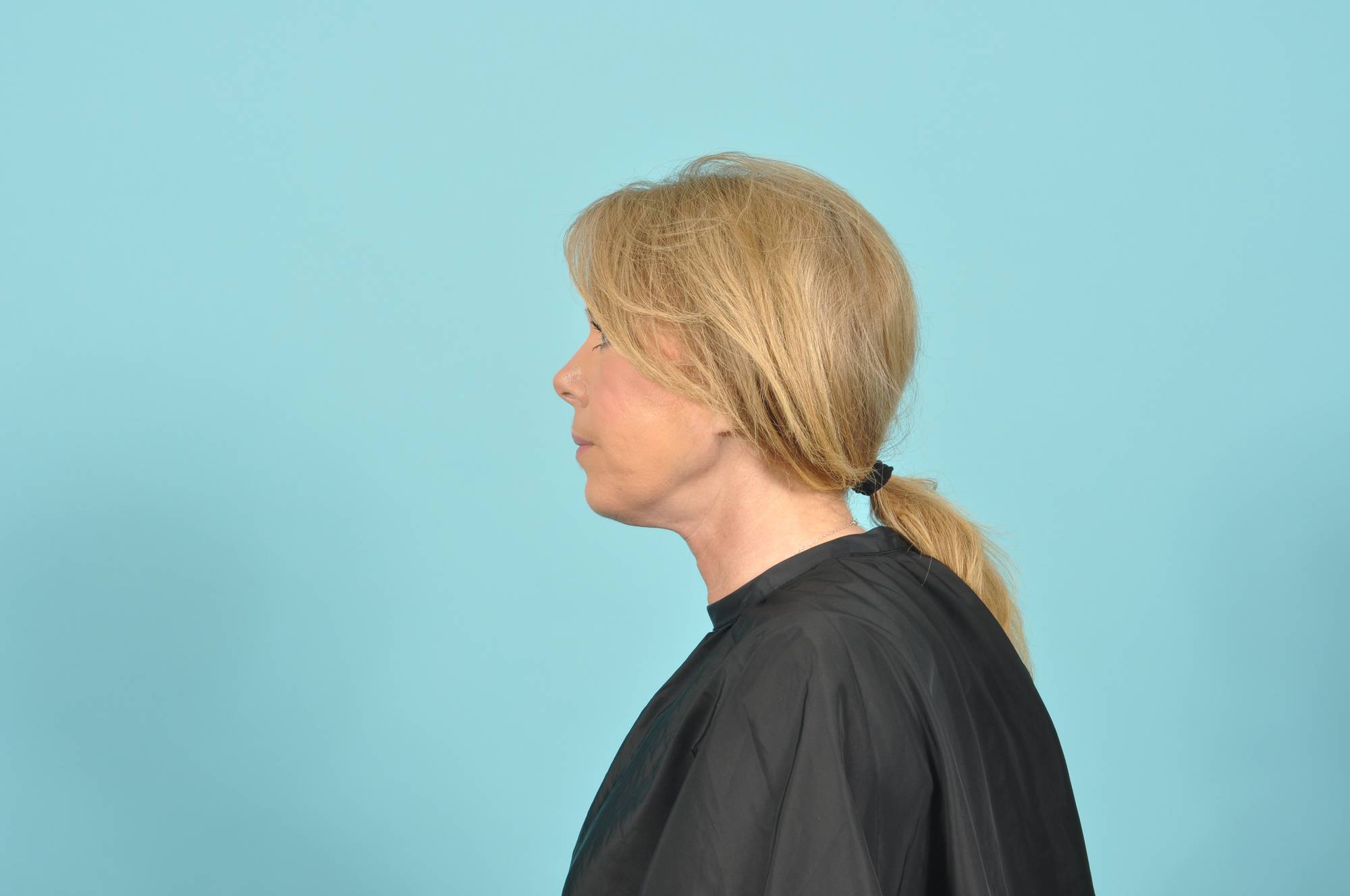 Facelift Before & After Image