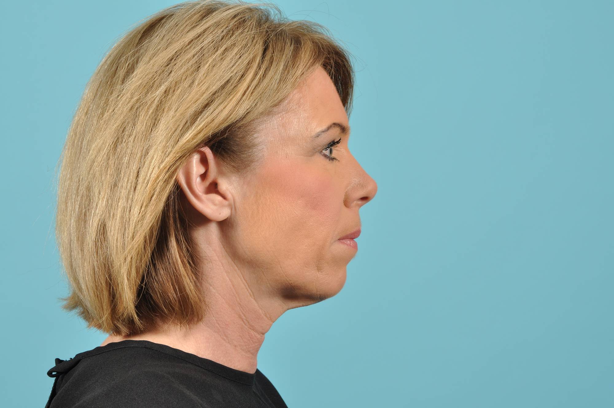  Before & After Image