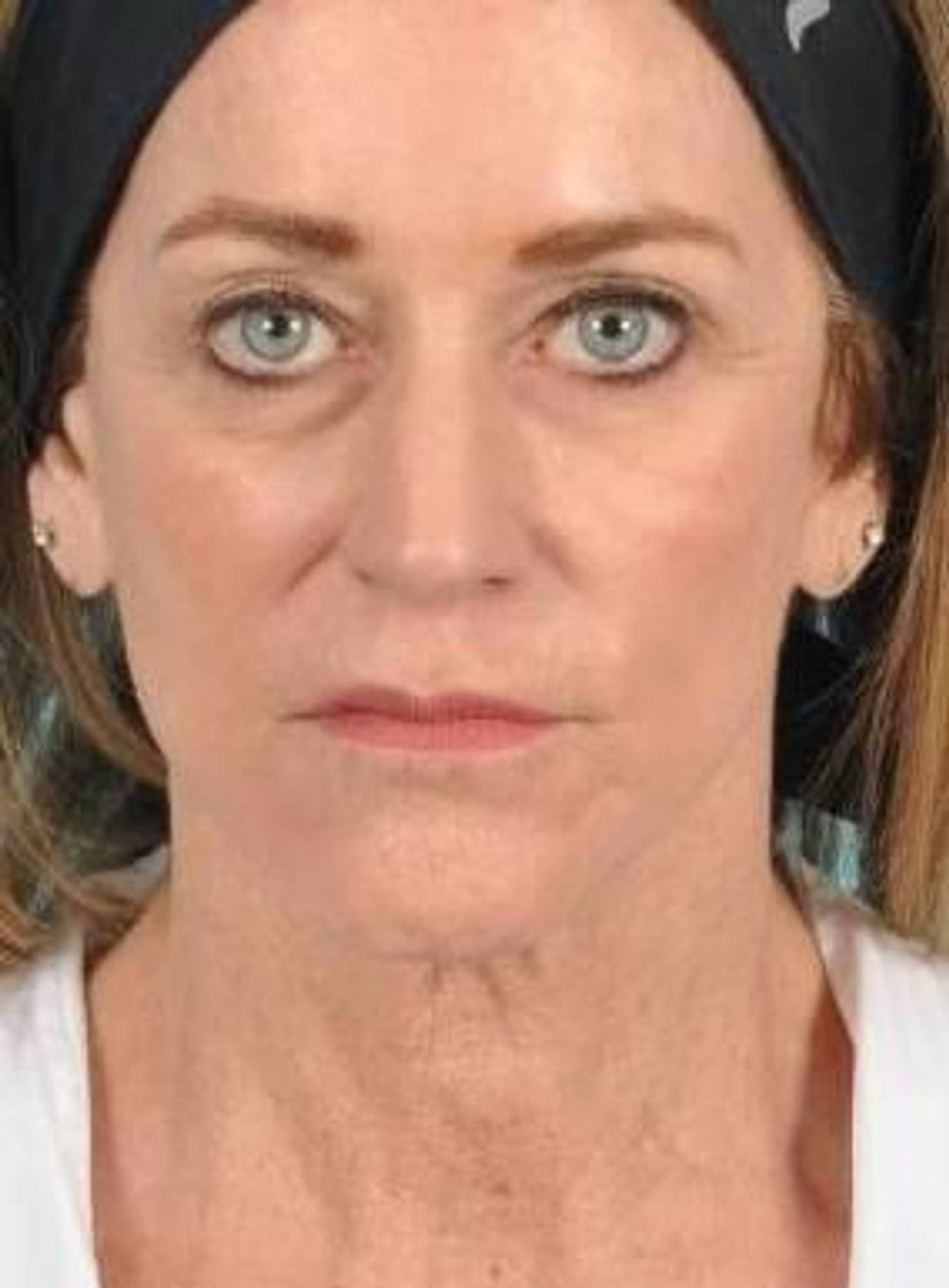 Facial Fat Grafting Before & After Image