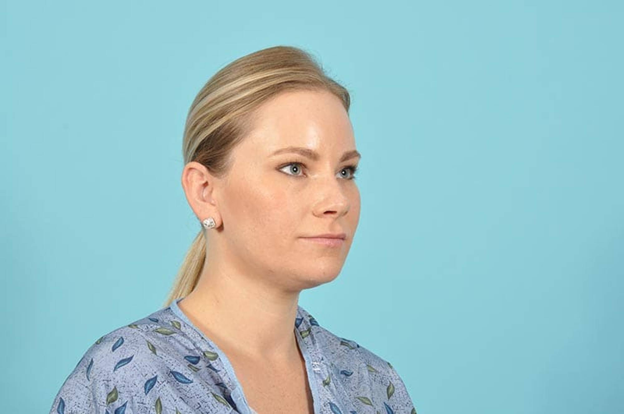 Lip Lift Before & After Image