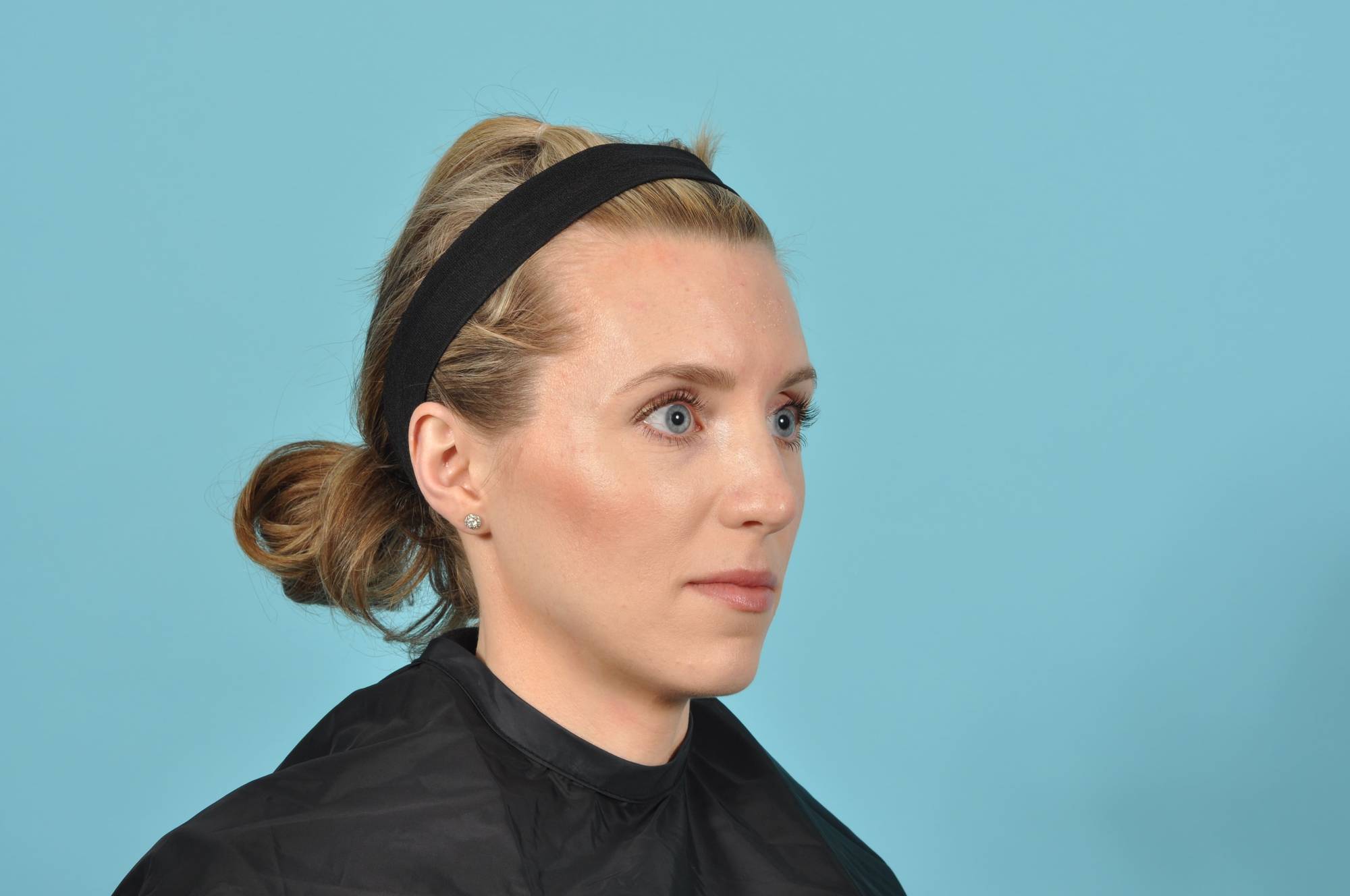 Rhinoplasty Before & After Image