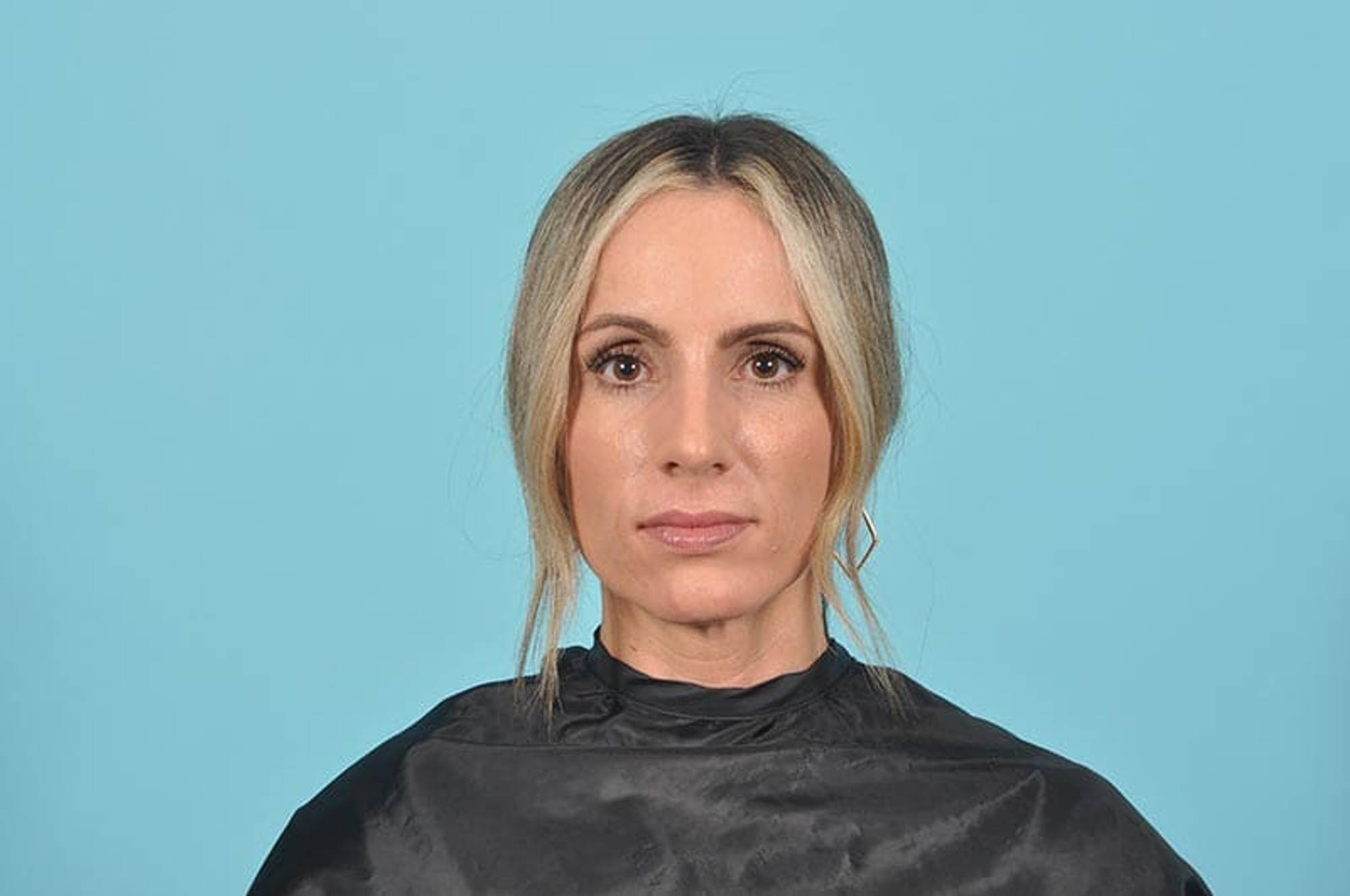 Rhinoplasty Before & After Image