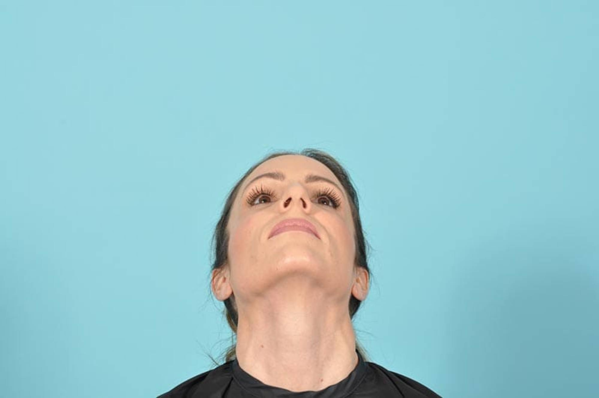 Rhinoplasty Before & After Image