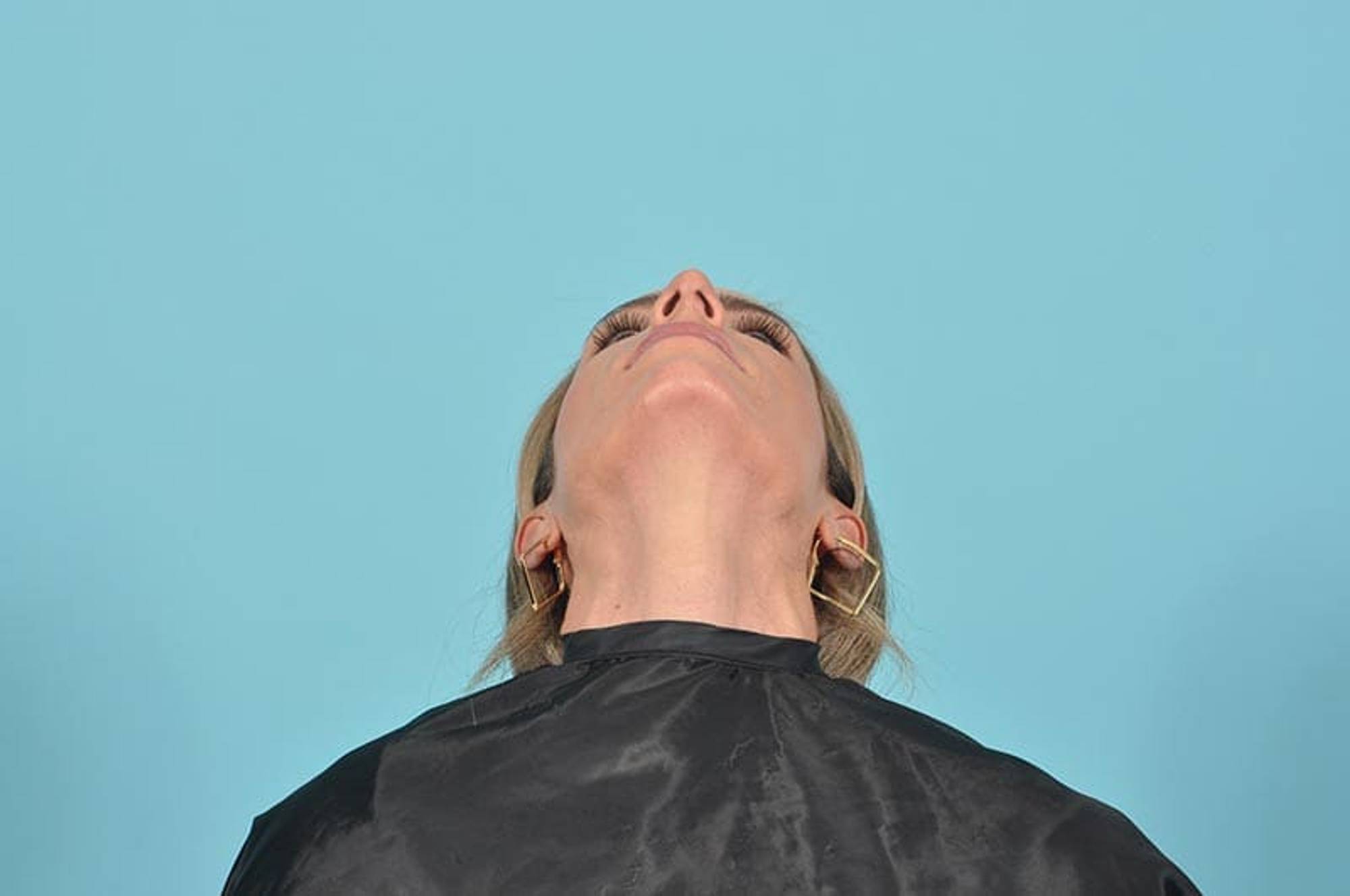 Rhinoplasty Before & After Image