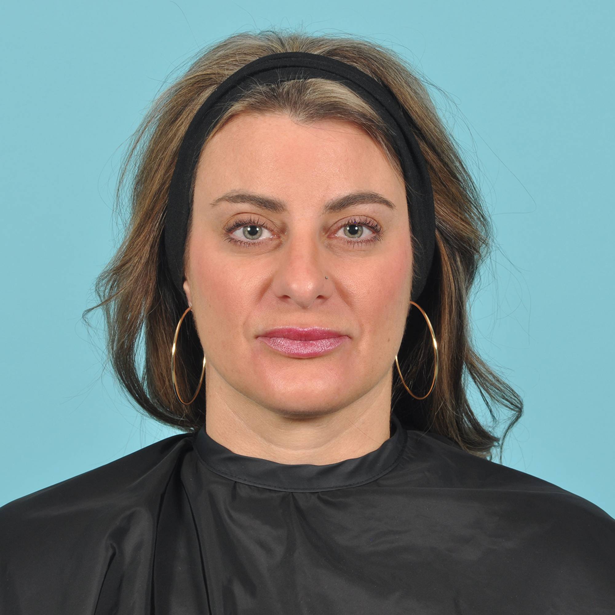 Rhinoplasty Before & After Image