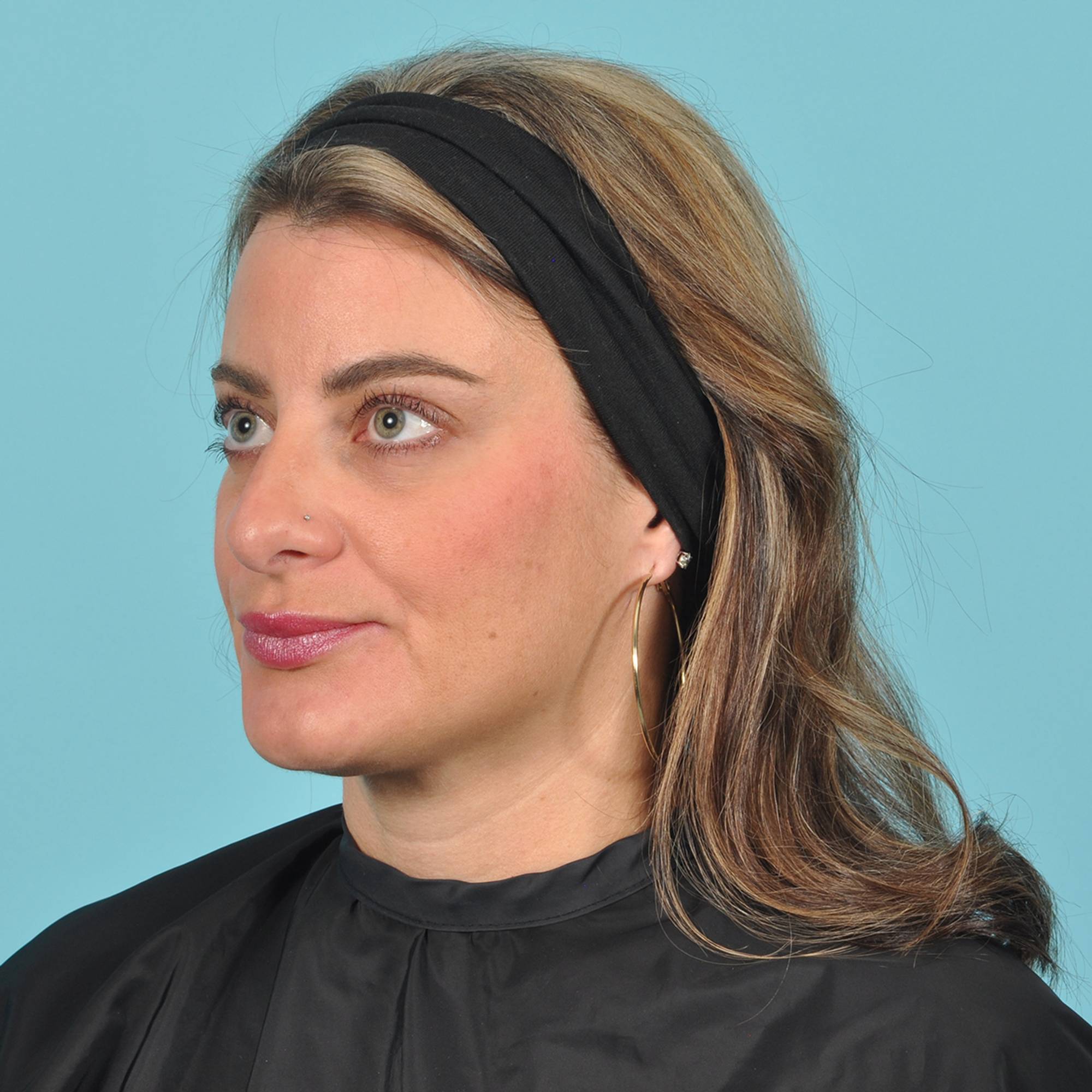 Rhinoplasty Before & After Image