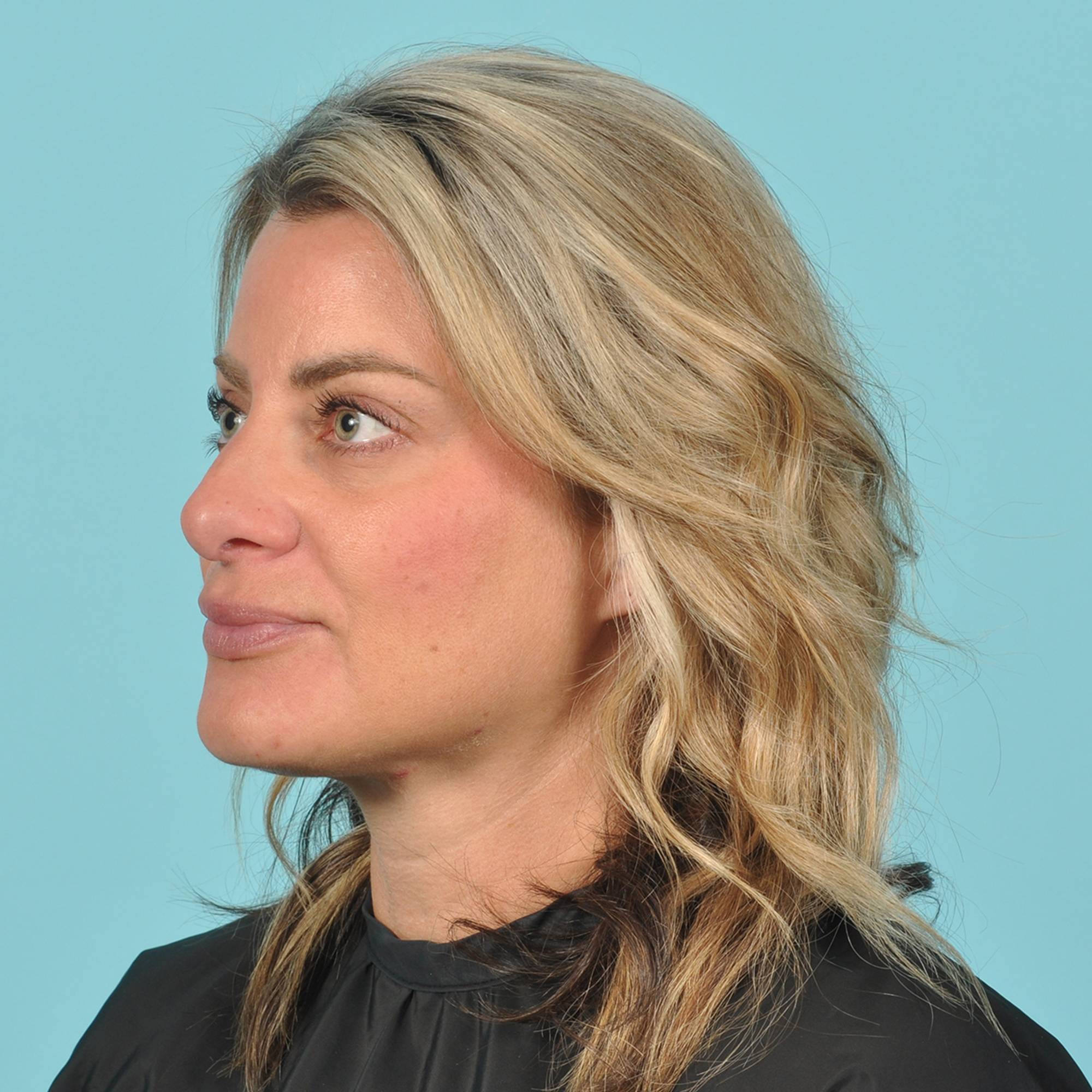 Rhinoplasty Before & After Image