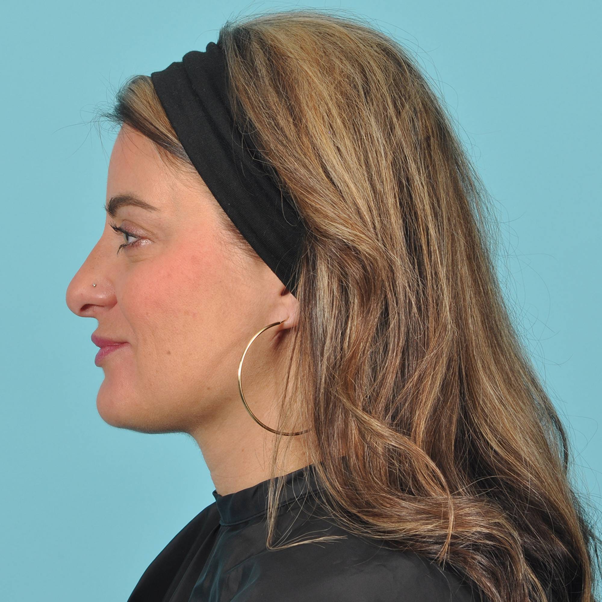 Rhinoplasty Before & After Image