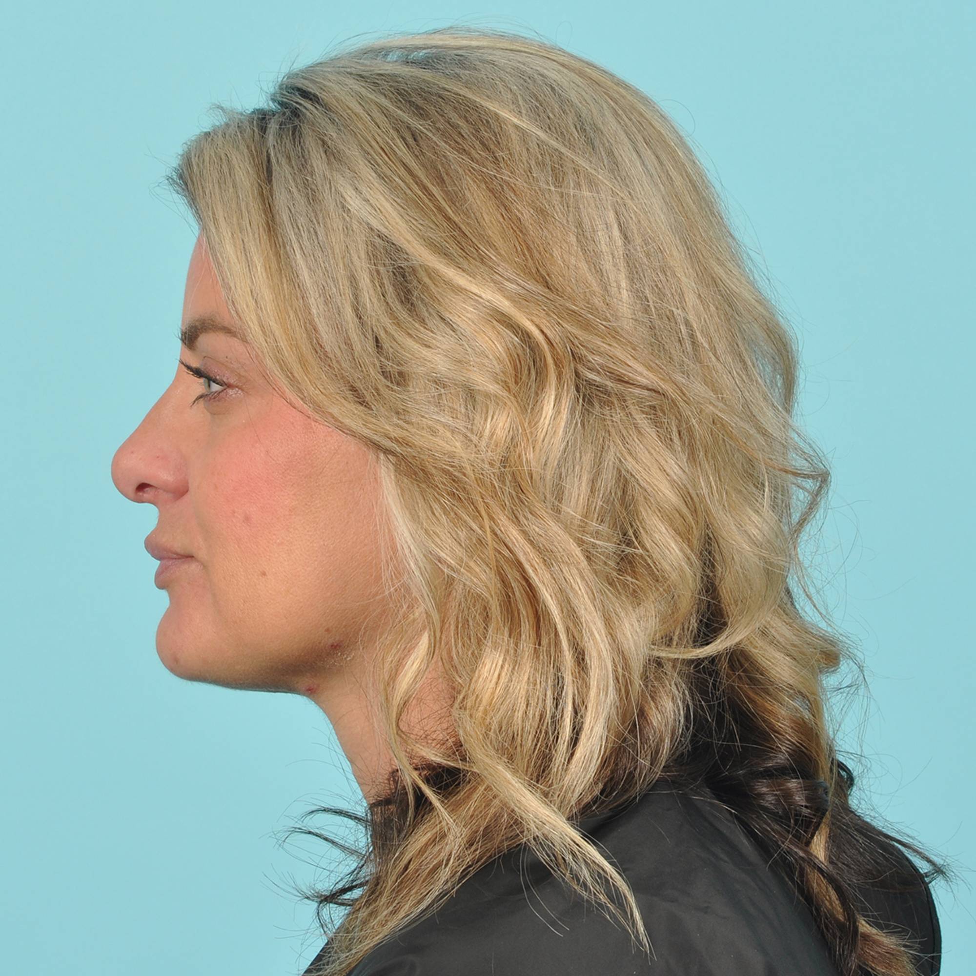 Rhinoplasty Before & After Image