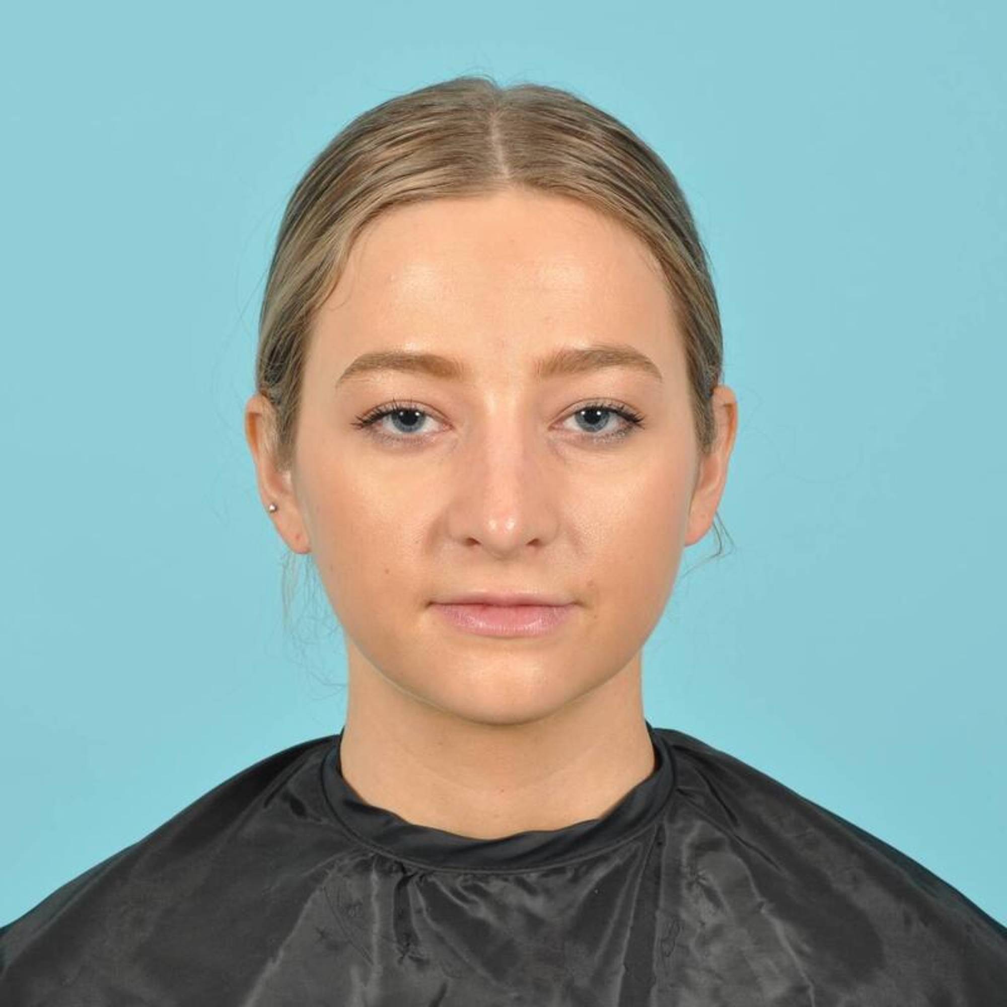 Rhinoplasty Before & After Image