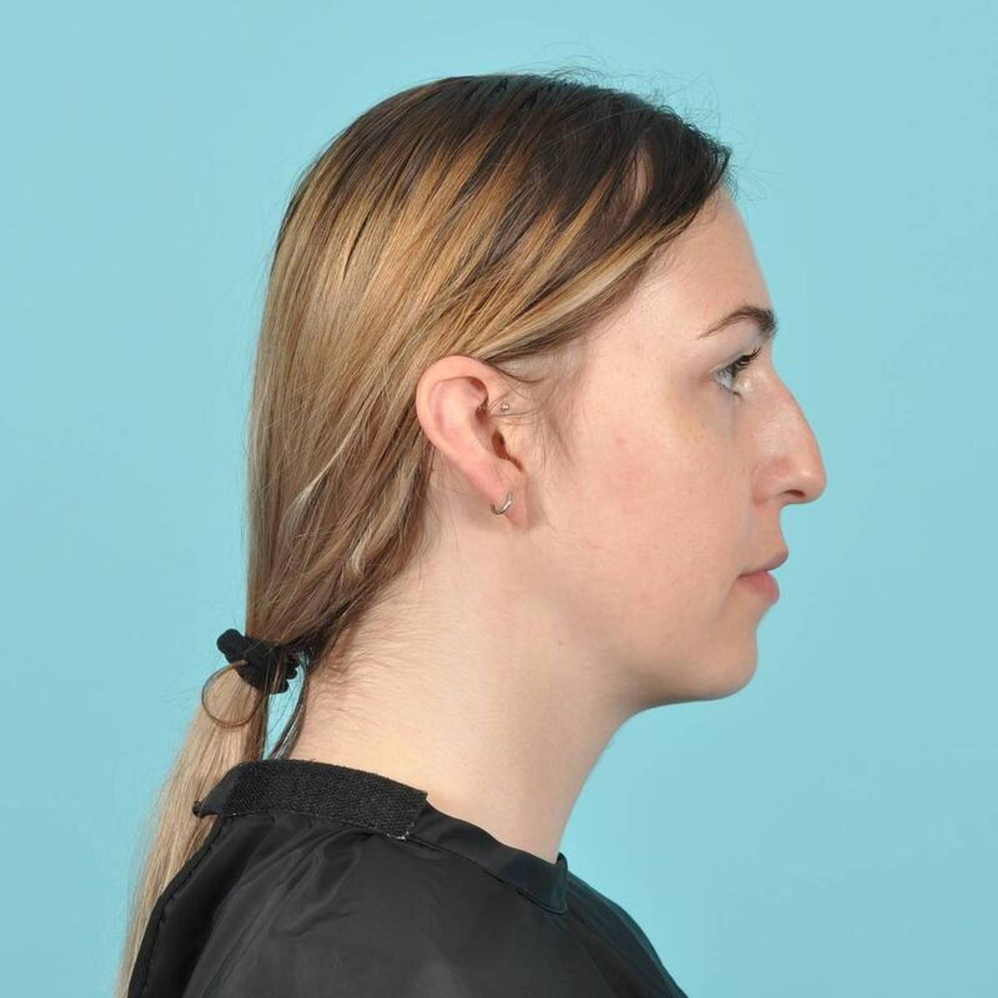  Before & After Image