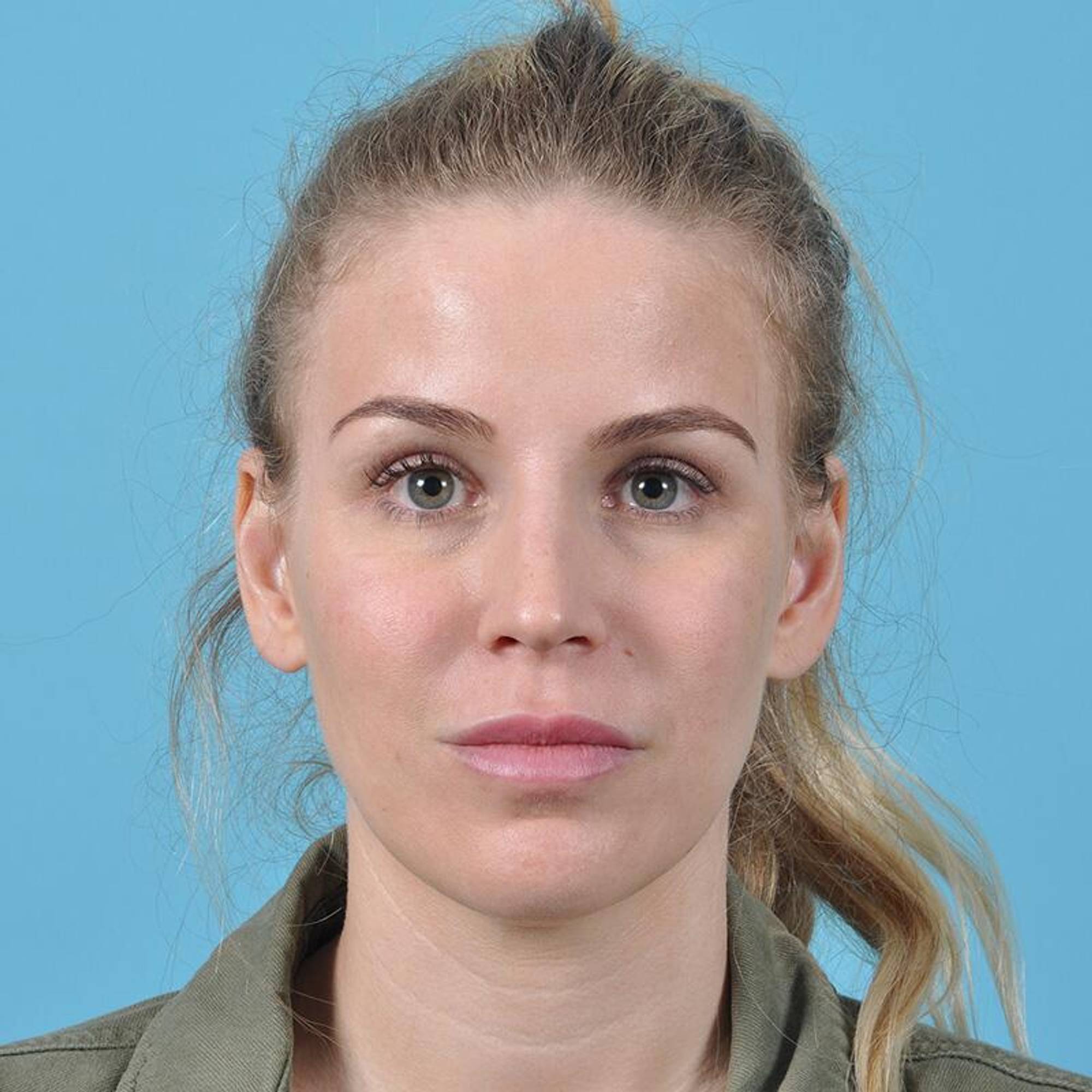 Rhinoplasty Before & After Image