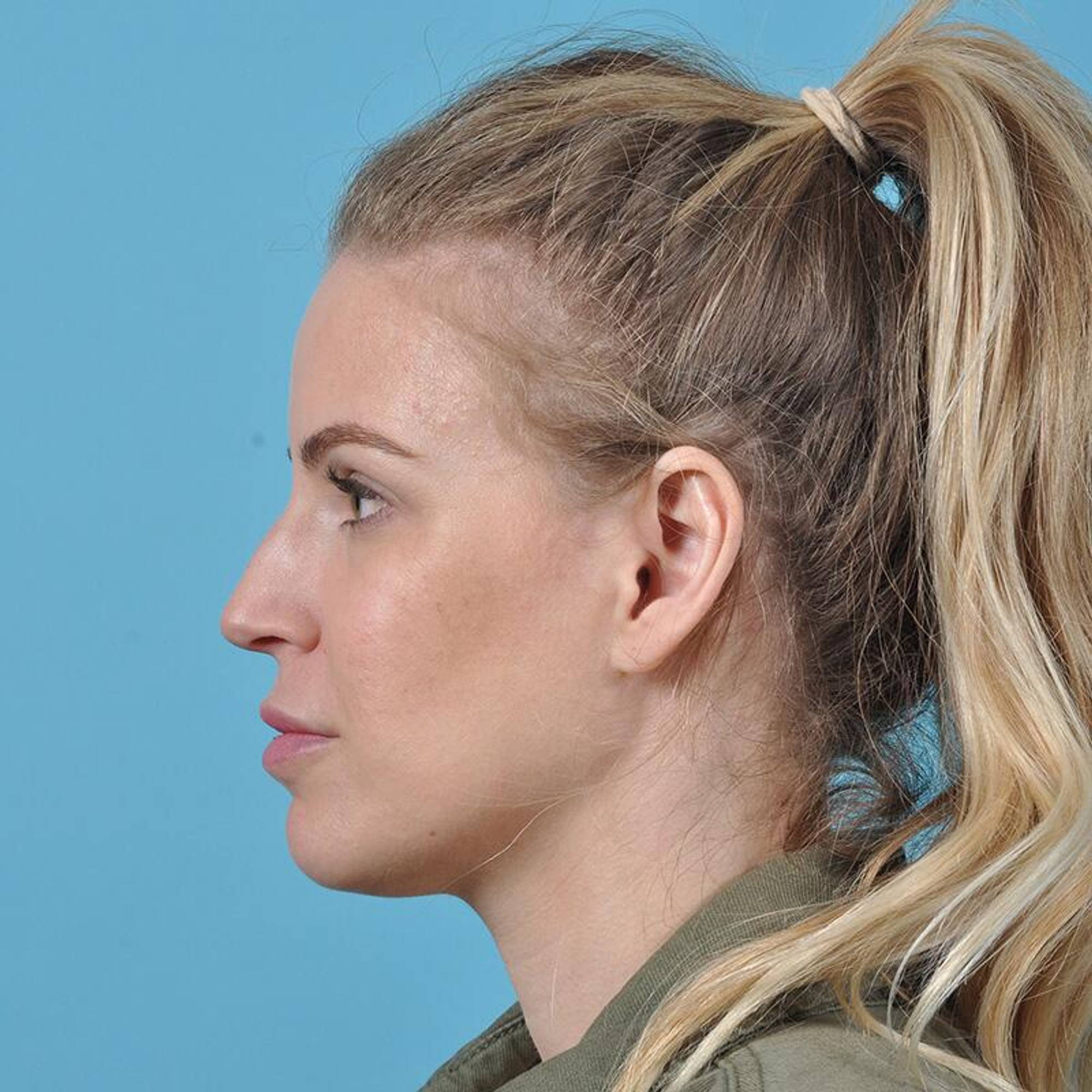 Rhinoplasty Before & After Image