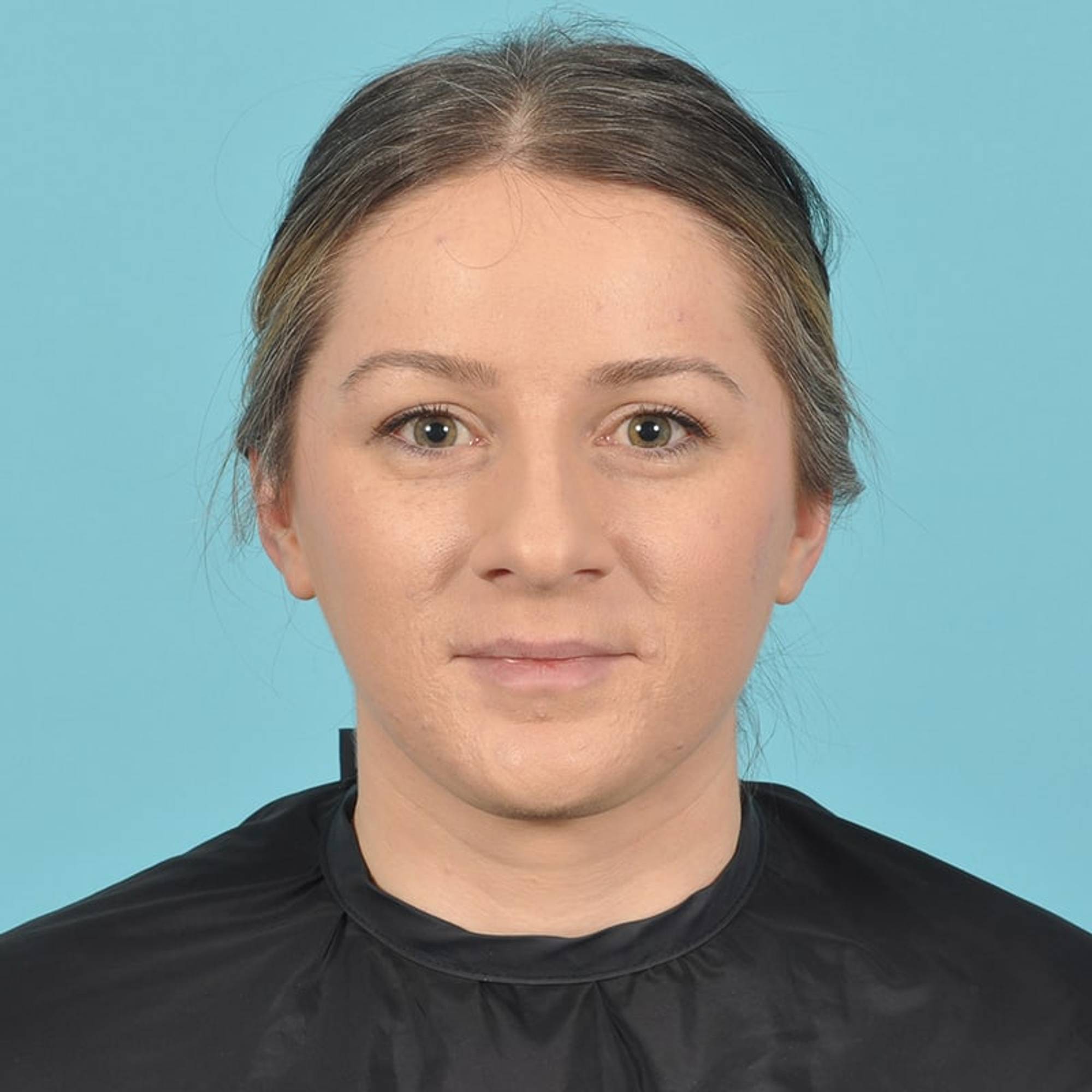 Rhinoplasty Before & After Image