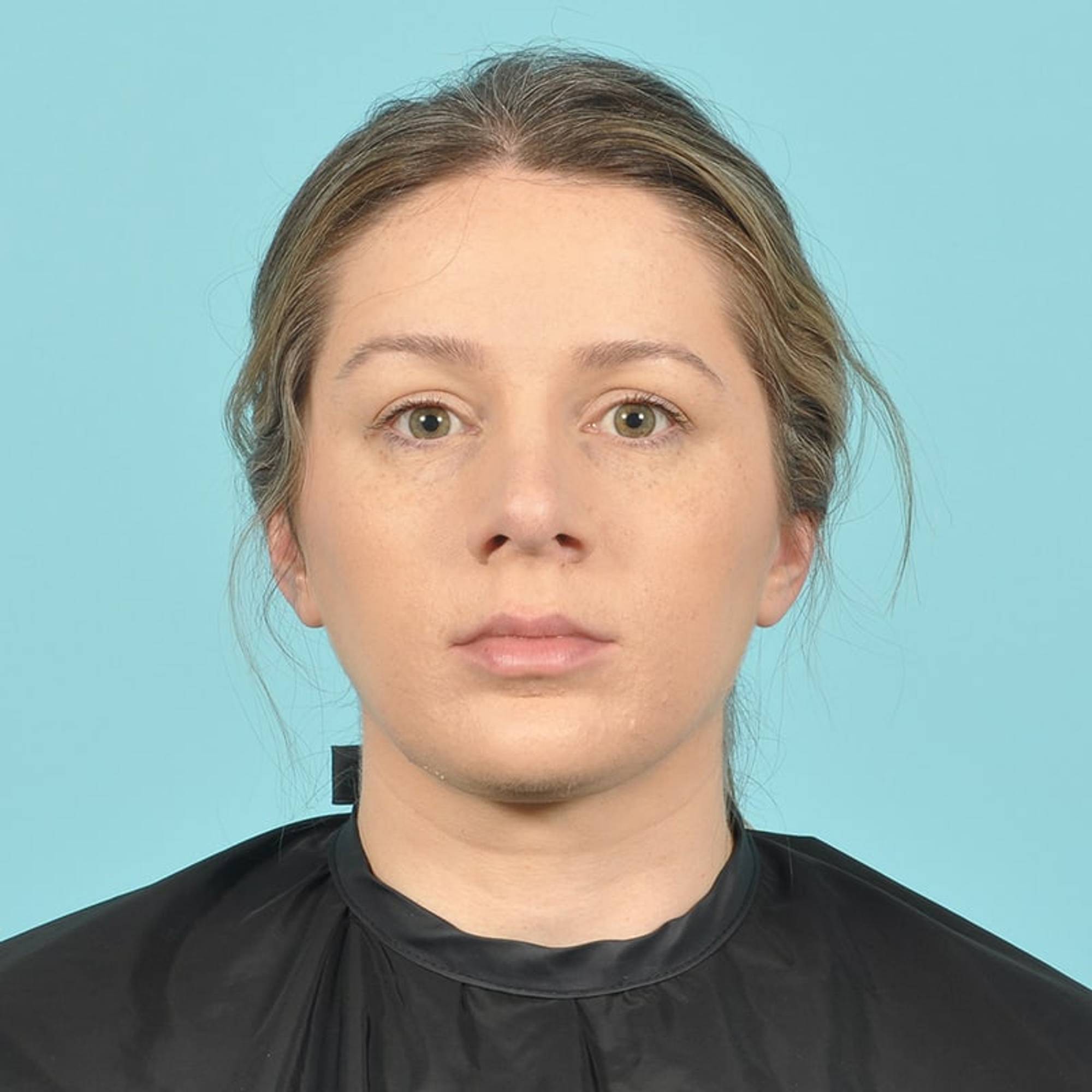 Rhinoplasty Before & After Image