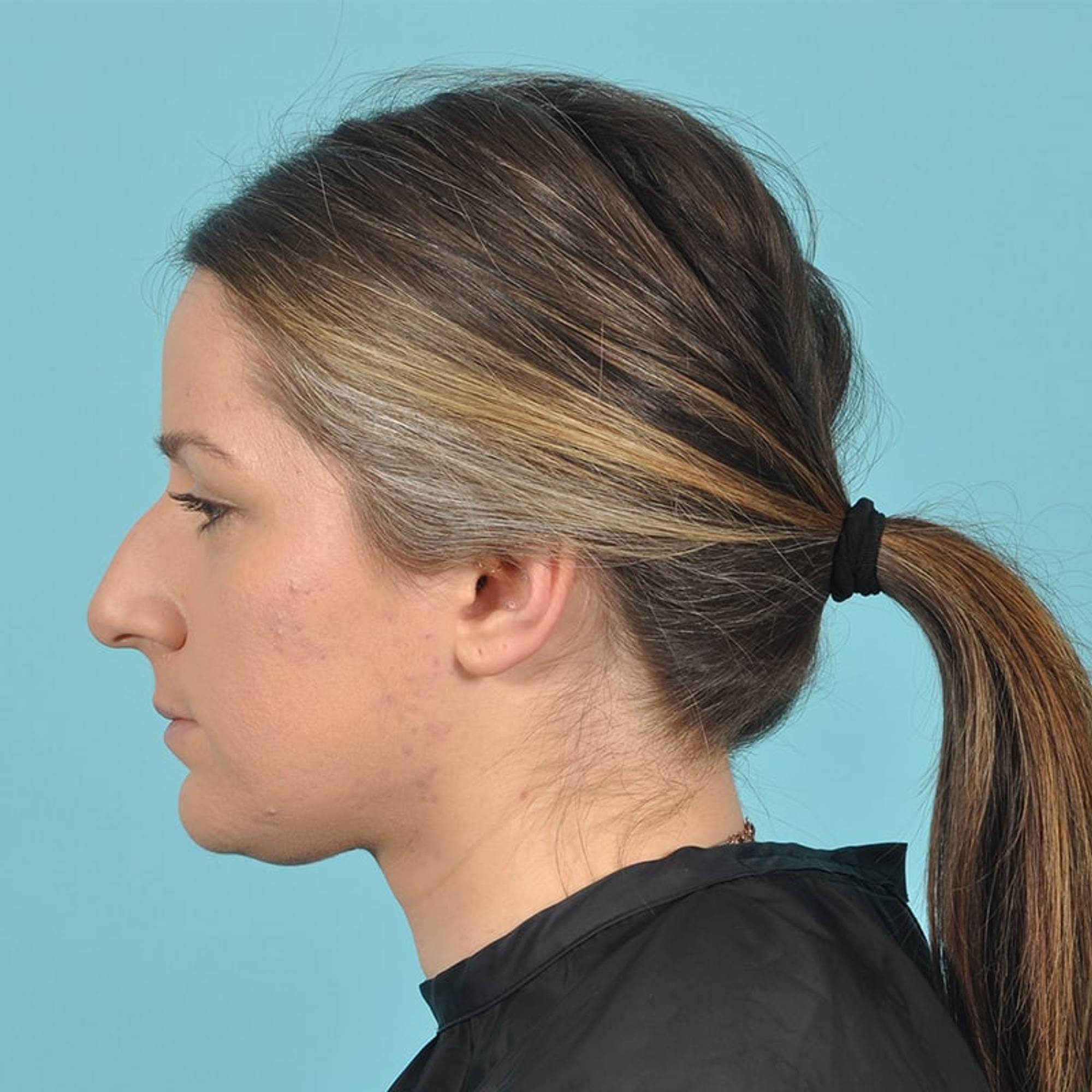 Rhinoplasty Before & After Image