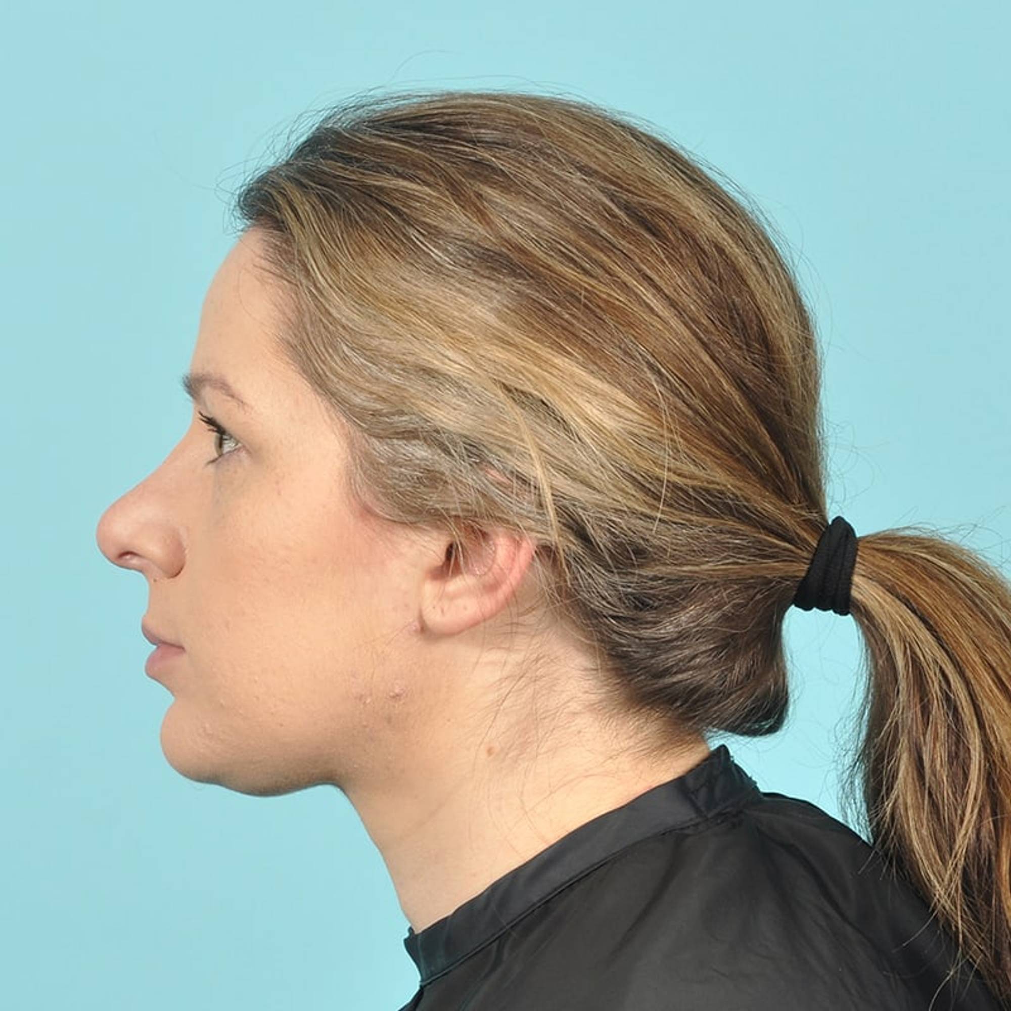 Rhinoplasty Before & After Image