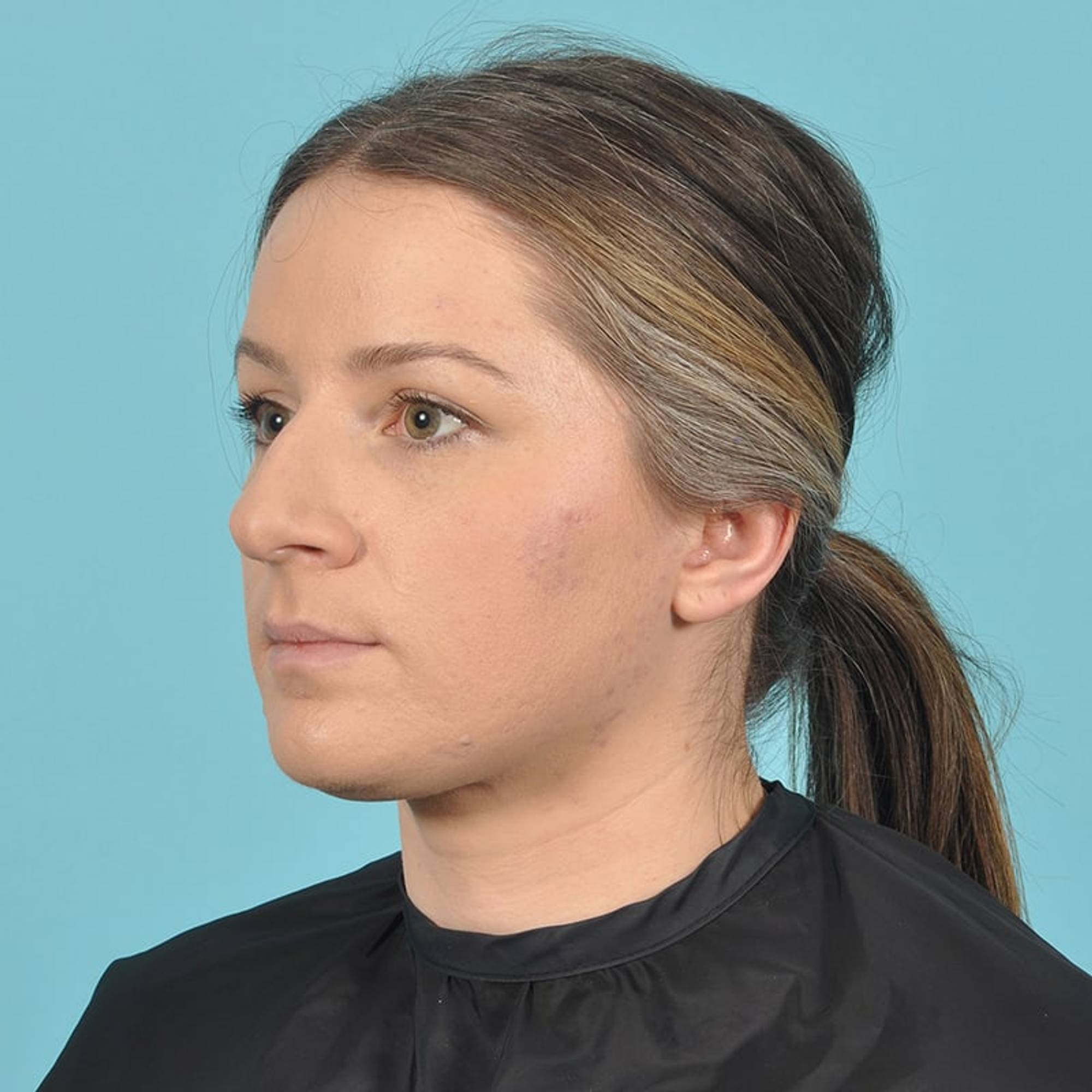 Rhinoplasty Before & After Image