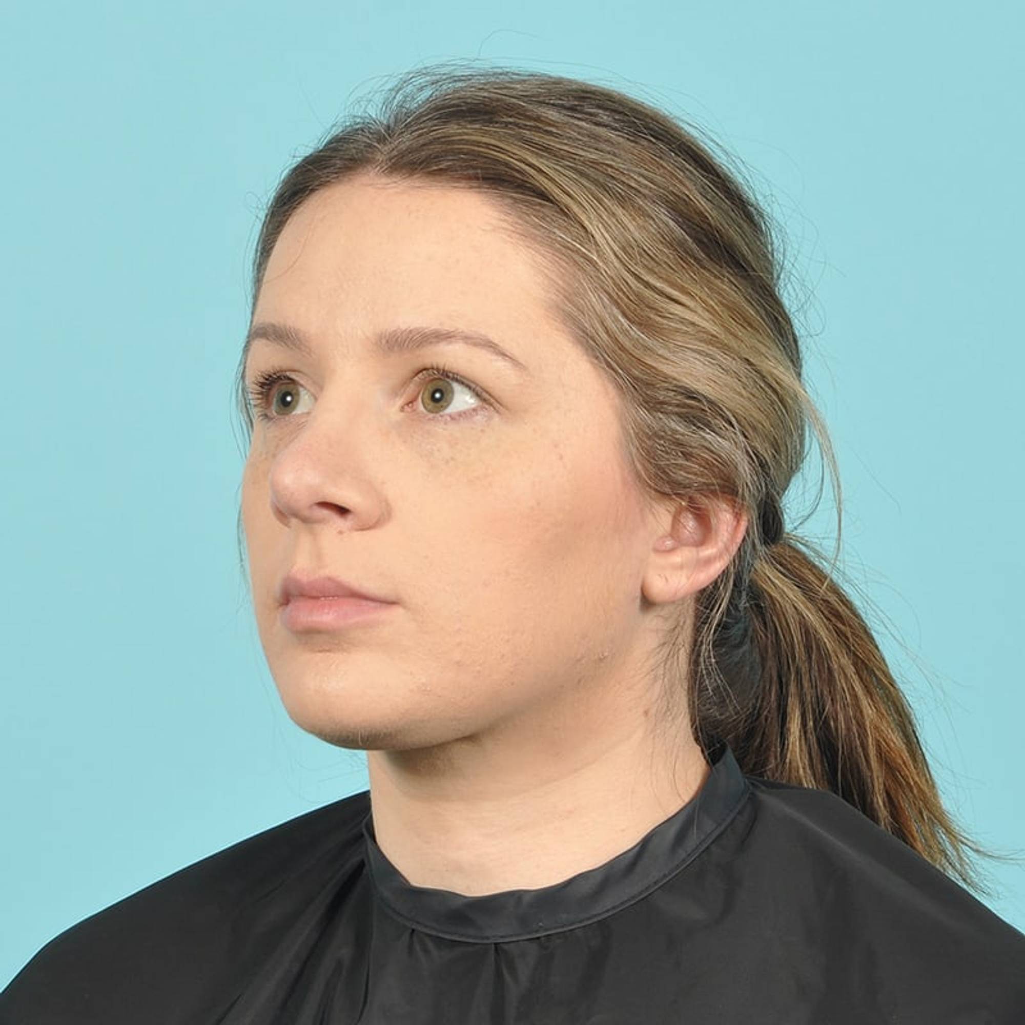 Rhinoplasty Before & After Image