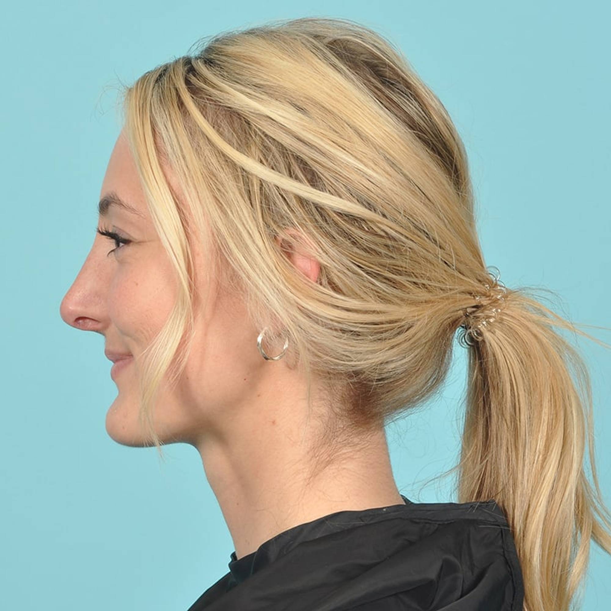 Rhinoplasty Before & After Image