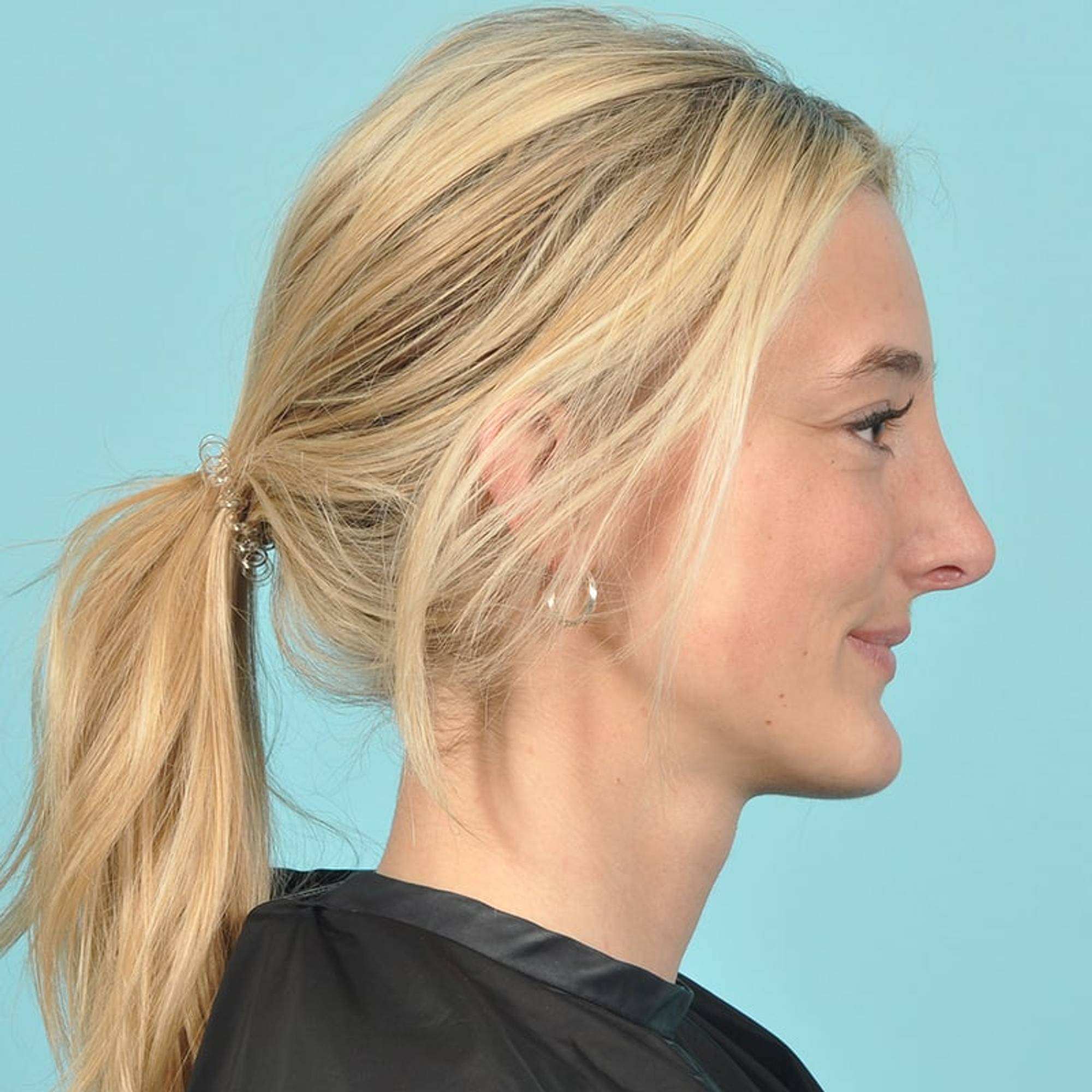 Rhinoplasty Before & After Image