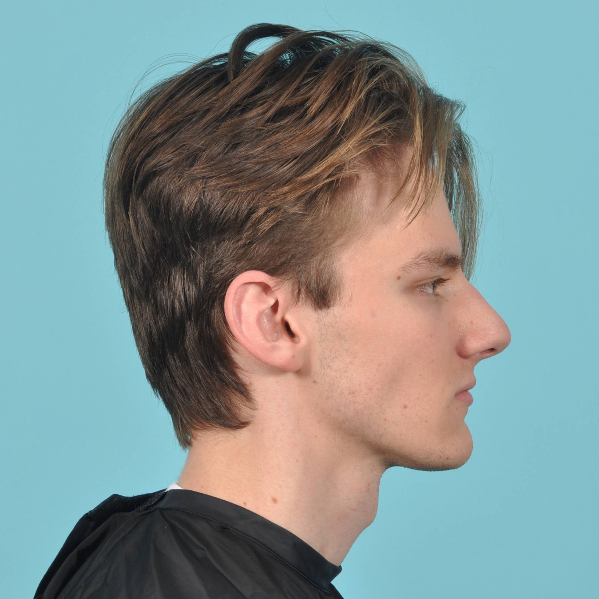 Rhinoplasty Before & After Image