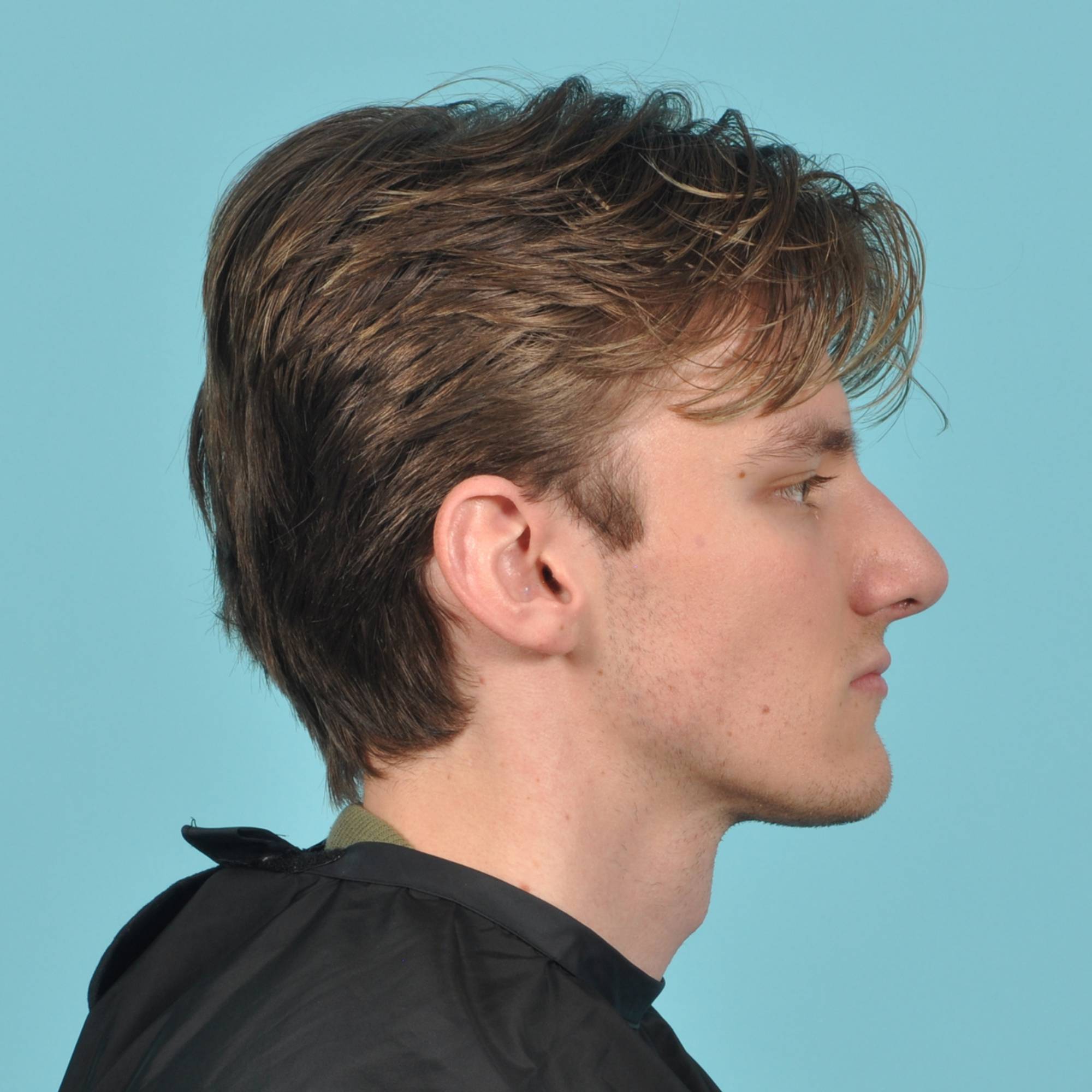 Rhinoplasty Before & After Image