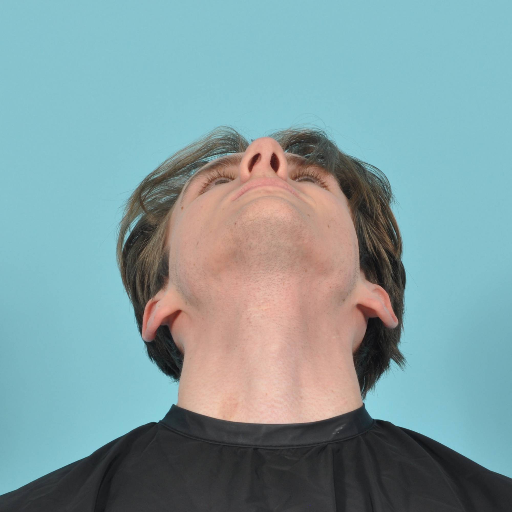 Rhinoplasty Before & After Image