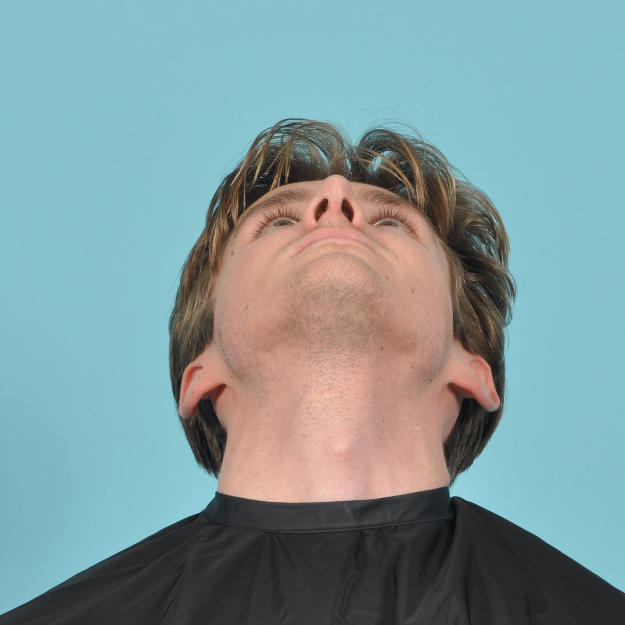 Rhinoplasty Before & After Image