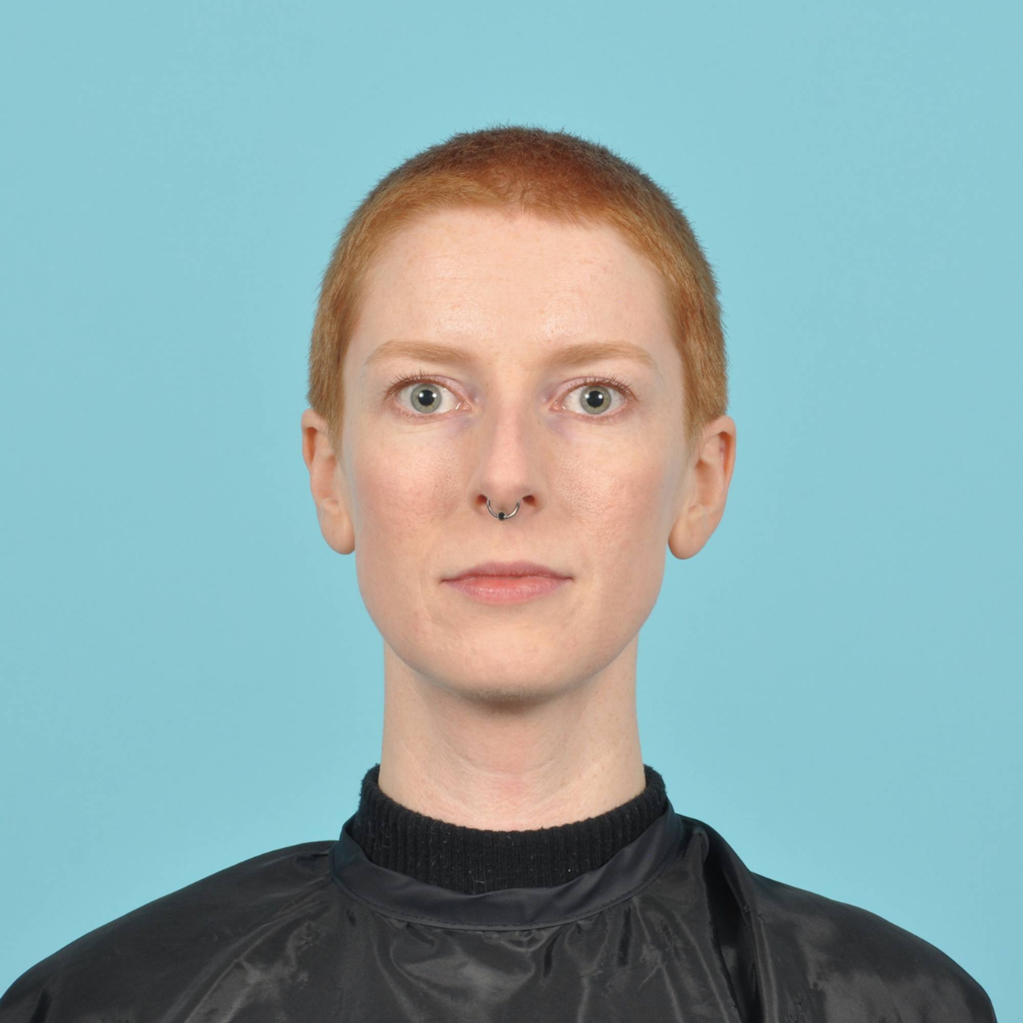 Rhinoplasty Before & After Image