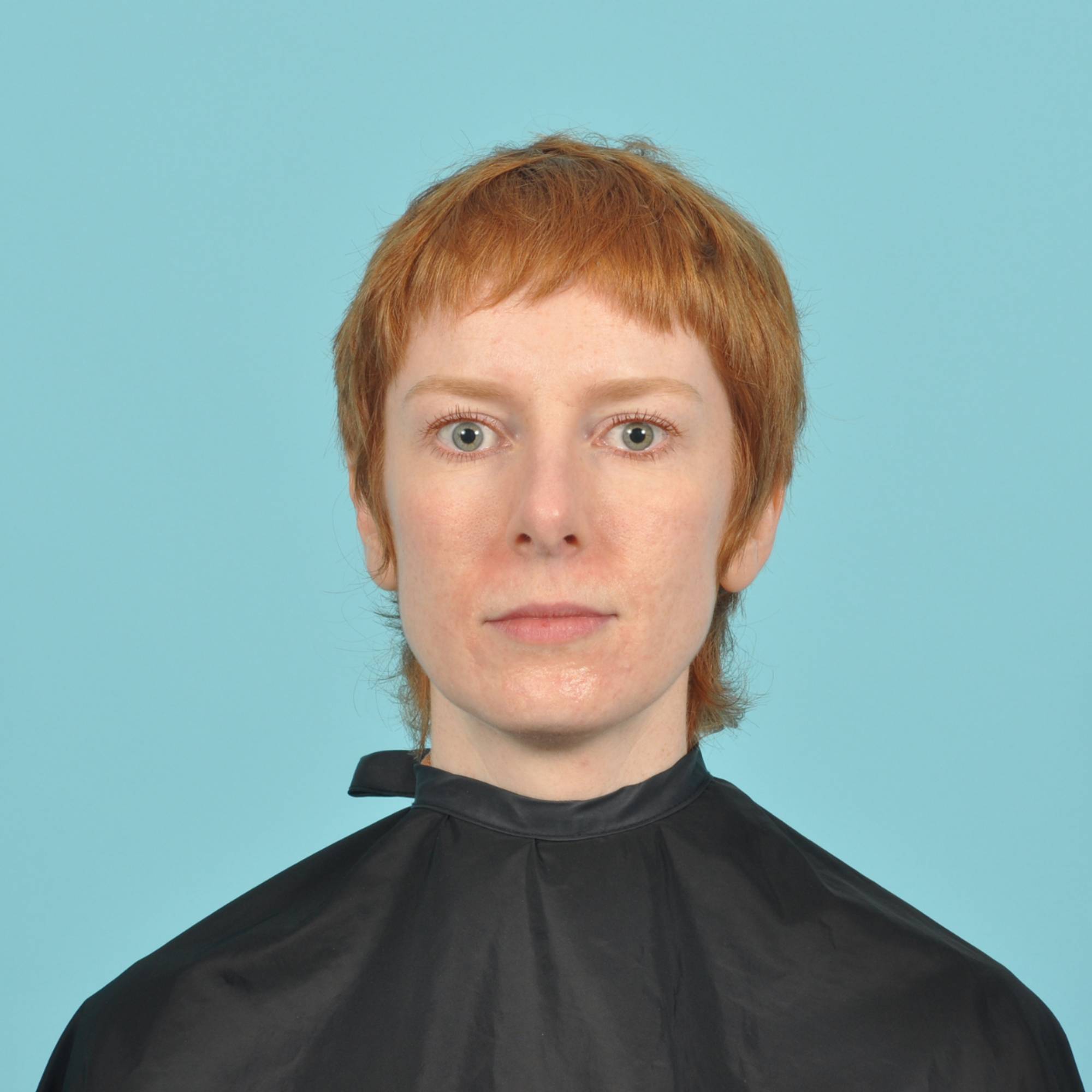 Rhinoplasty Before & After Image