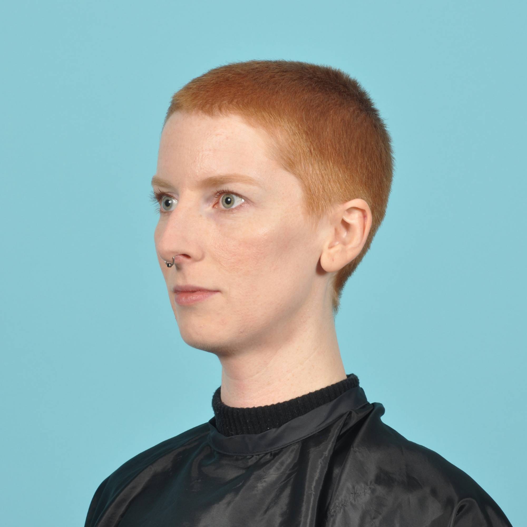 Rhinoplasty Before & After Image