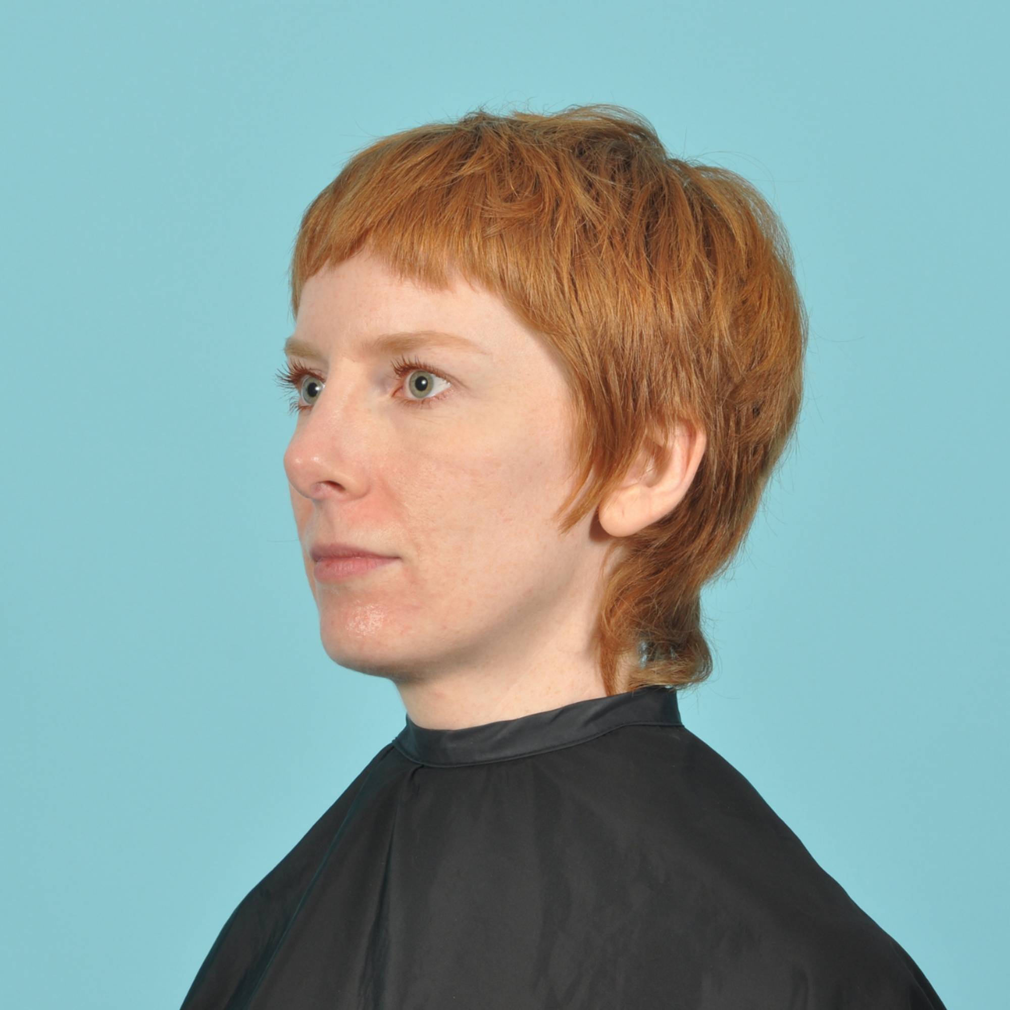 Rhinoplasty Before & After Image