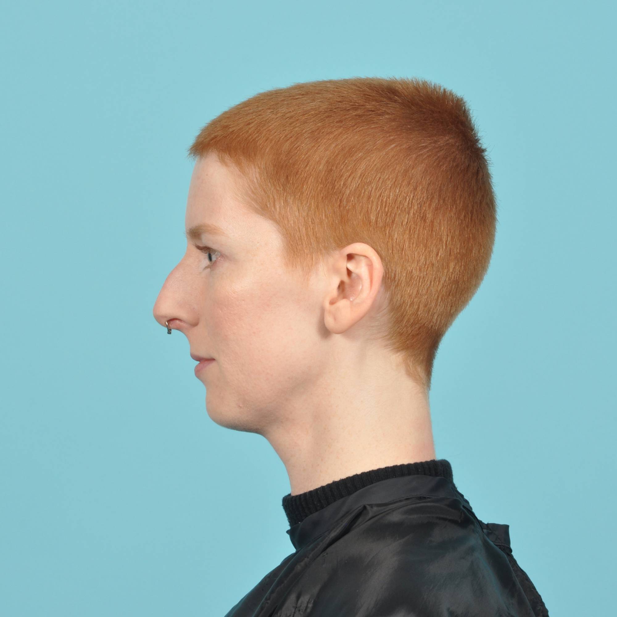 Rhinoplasty Before & After Image