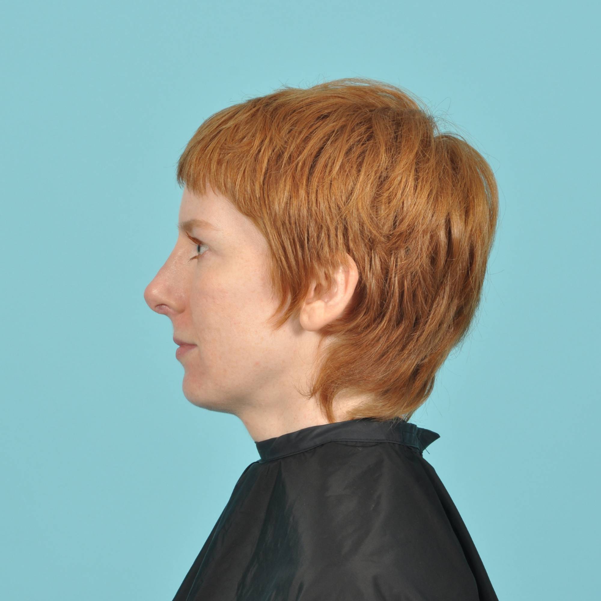 Rhinoplasty Before & After Image