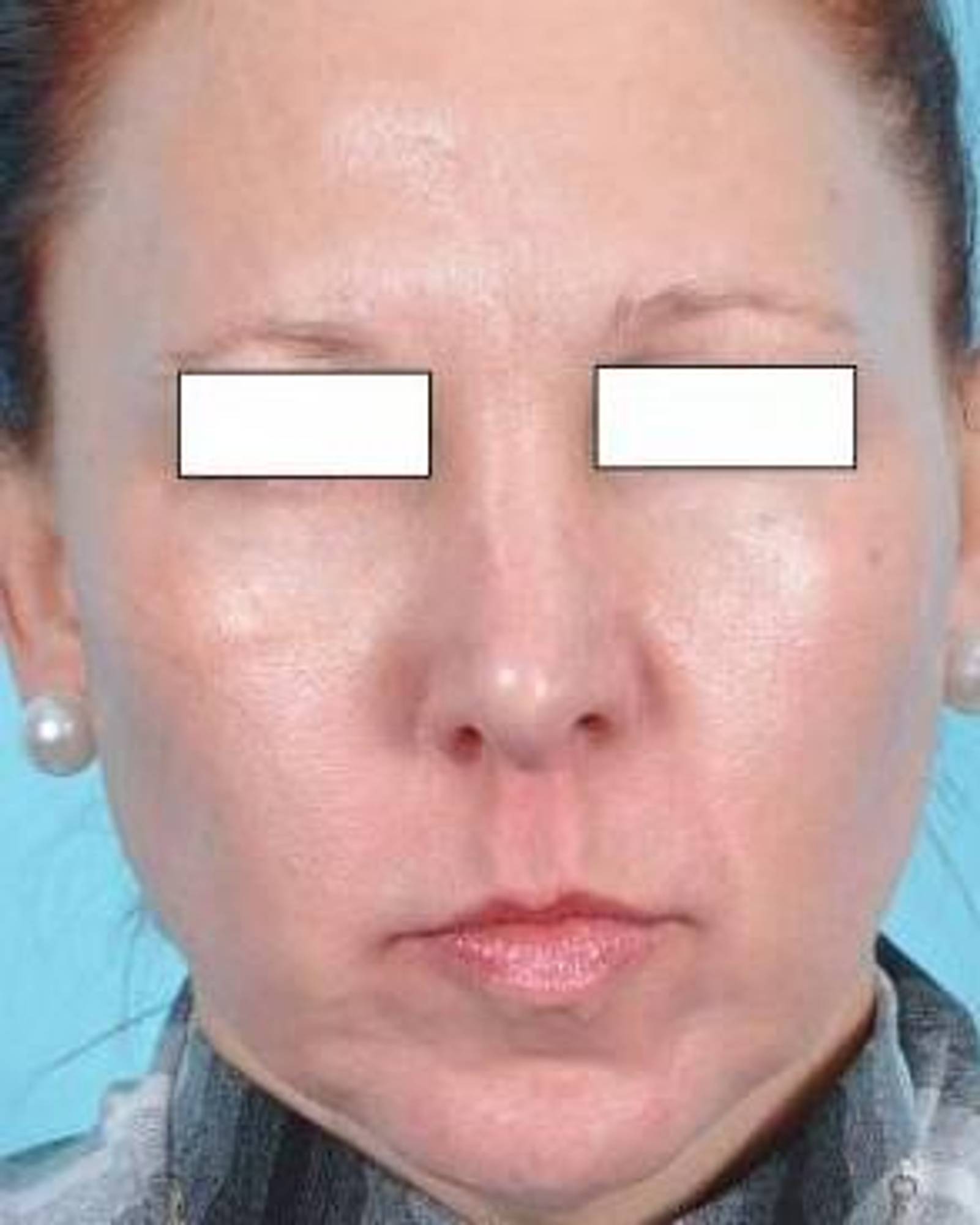 BOTOX Cosmetic Before & After Image