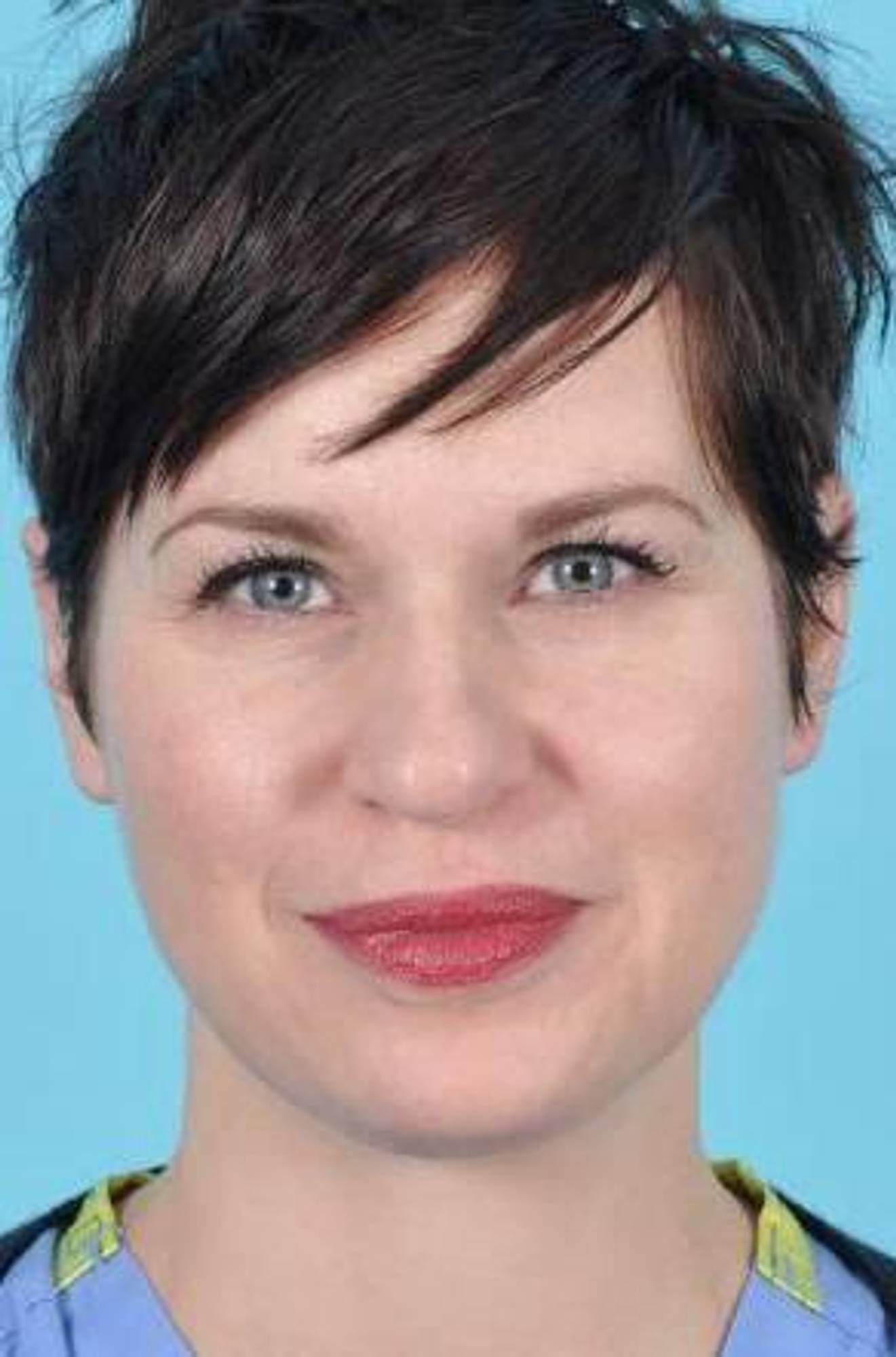 Facial Fillers Before & After Image