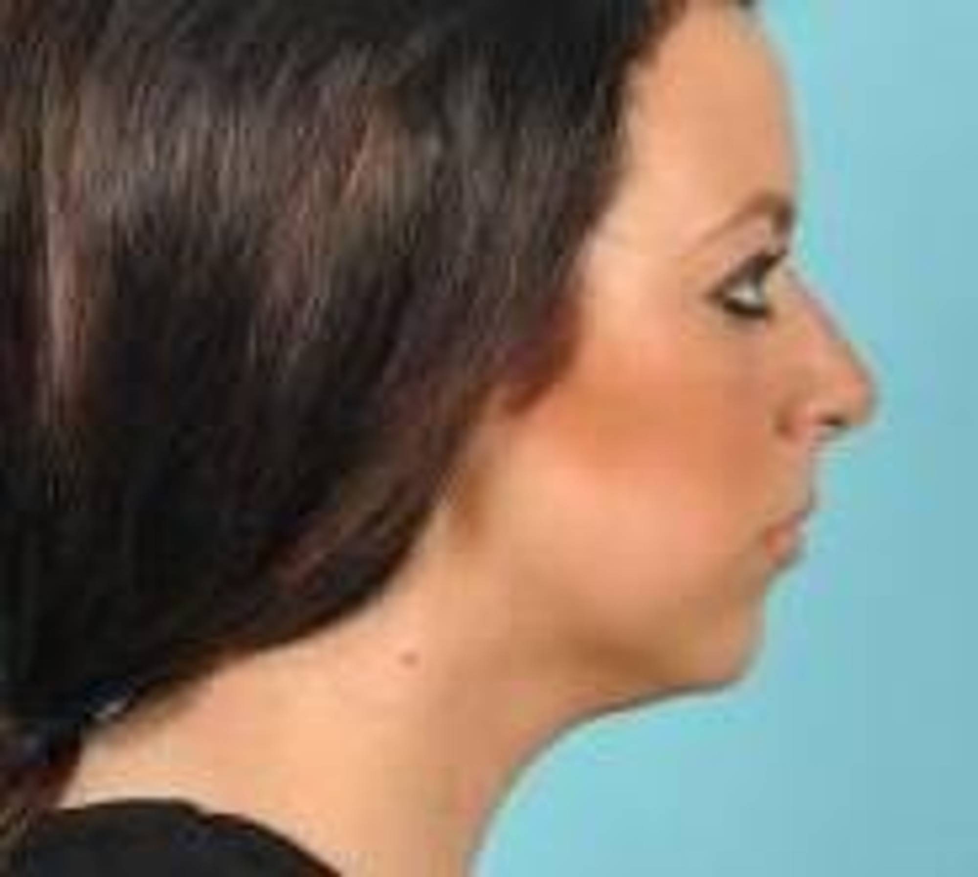 Kybella Before & After Image