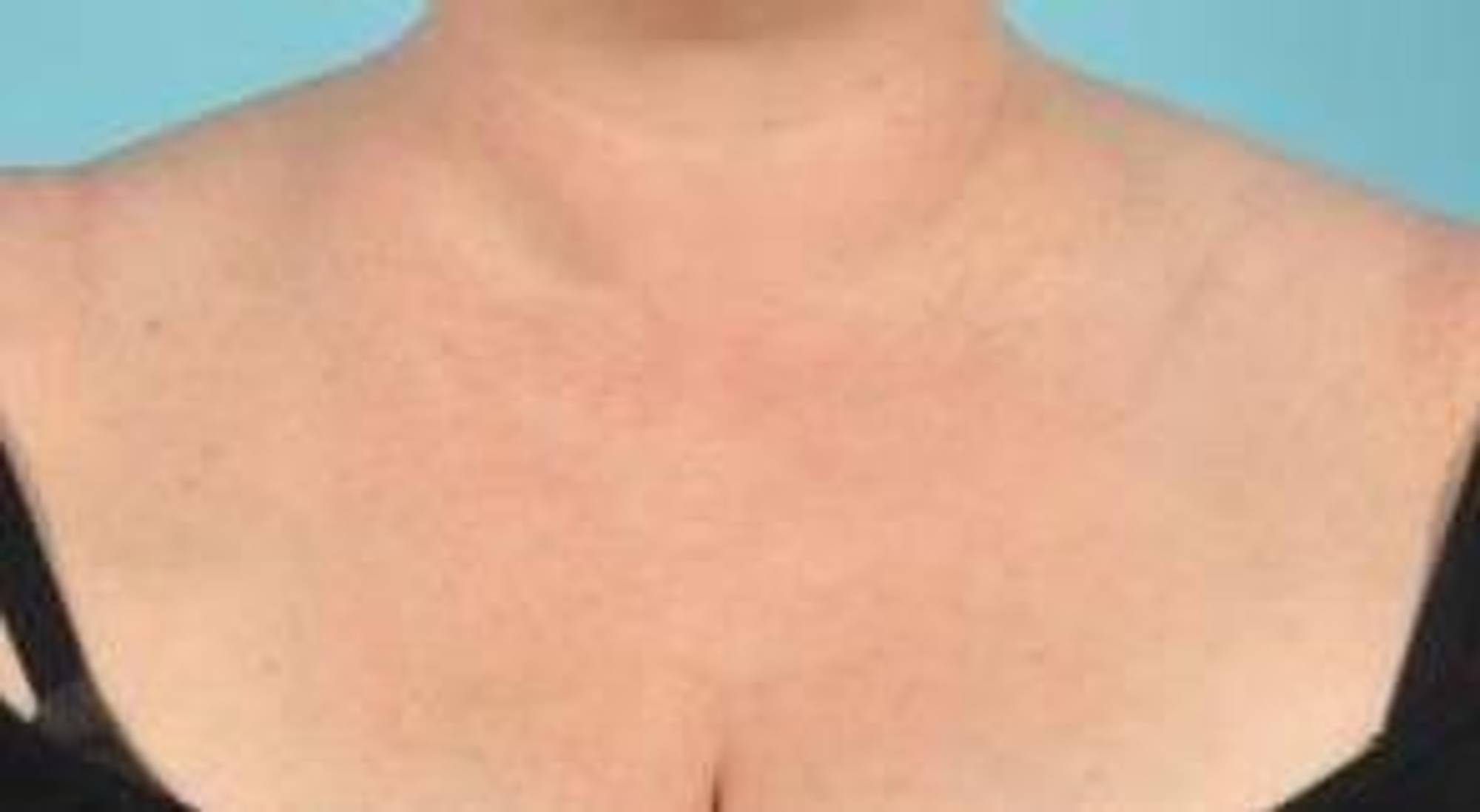 Laser Skin Resurfacing Before & After Image